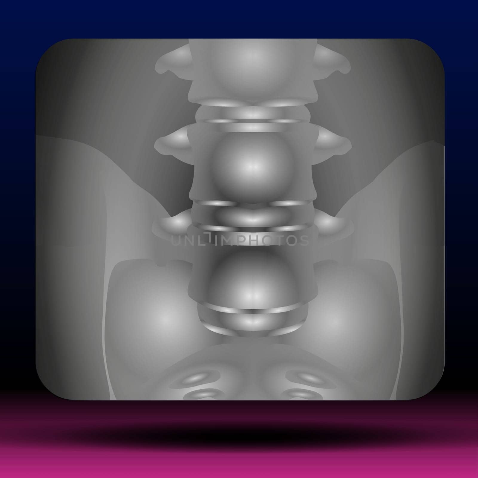 A common, painful condition affecting the lower portion of the spine. Low back pain is caused by injury to a muscle (strain) or ligament (sprain). Common causes include improper lifting, poor posture, lack of regular exercise, a fracture, a ruptured disc or arthritis. Often, the only symptom is pain in the lower back. Most low back pain goes away on its own in two to four weeks. Physiotherapy and pain relievers can help. A few cases may require surgery. Vector Illustration