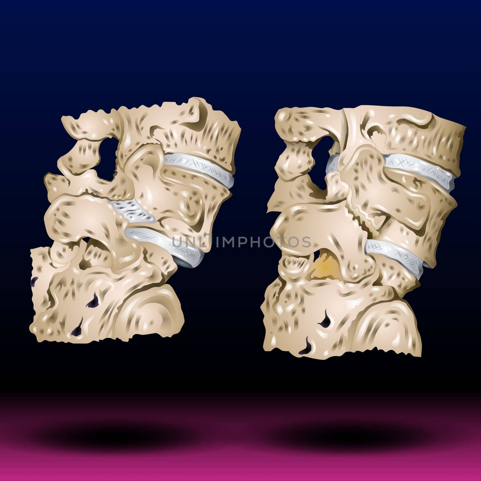 Spondylosis , Spondylolisthesis ( Film x-ray lumbo - sacral spine show spine collapse, decrease in disc space, bony spur formation ) ( side, lateral view ) and blank area Vector Illustration