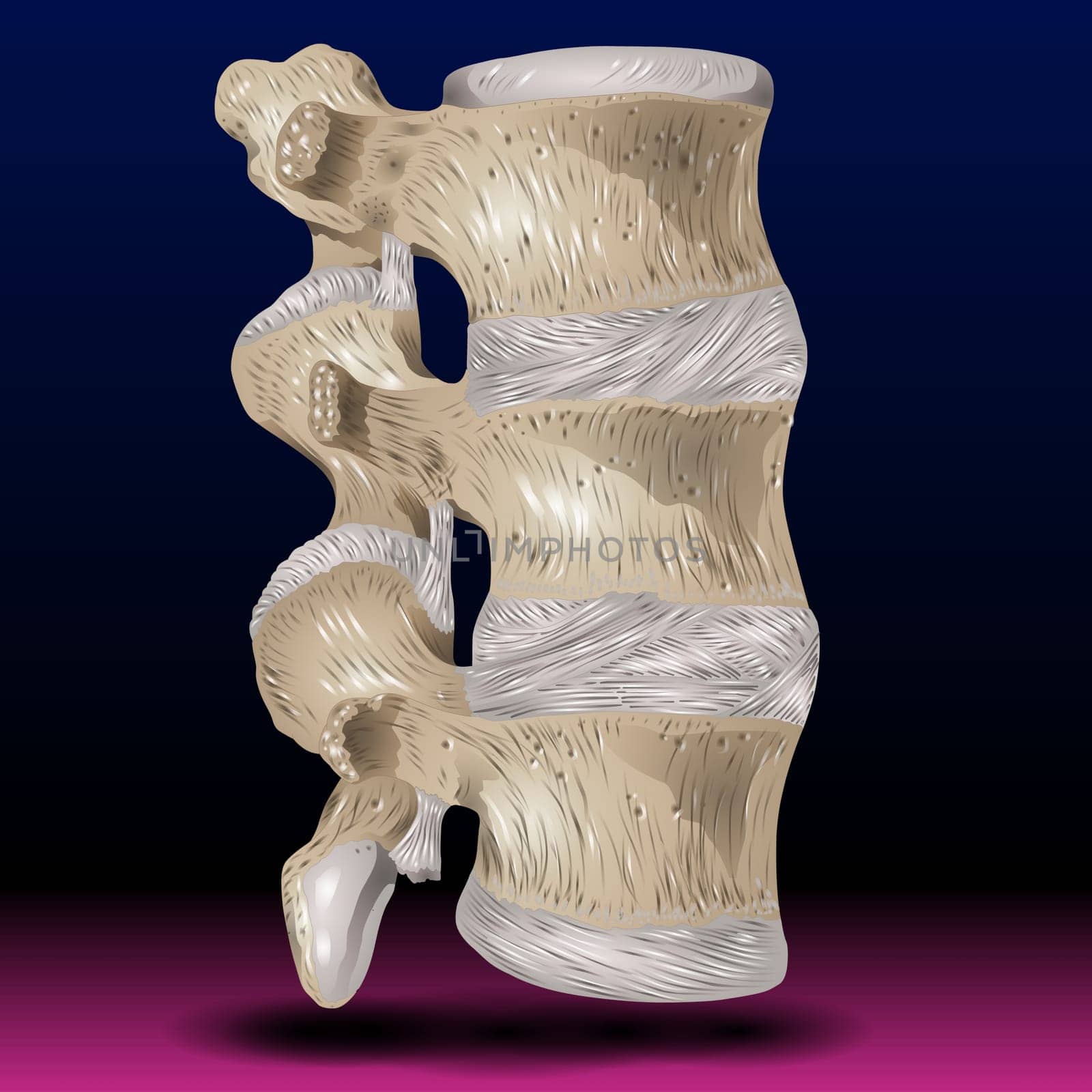 Ankylosing Spondylitis Realistic Vector Medical Chart with Human Vertebral Column Joints Inflammation and Bones Fusion Anatomical Illustration. Spine joint bones arthritis symptoms orthopedic concept.