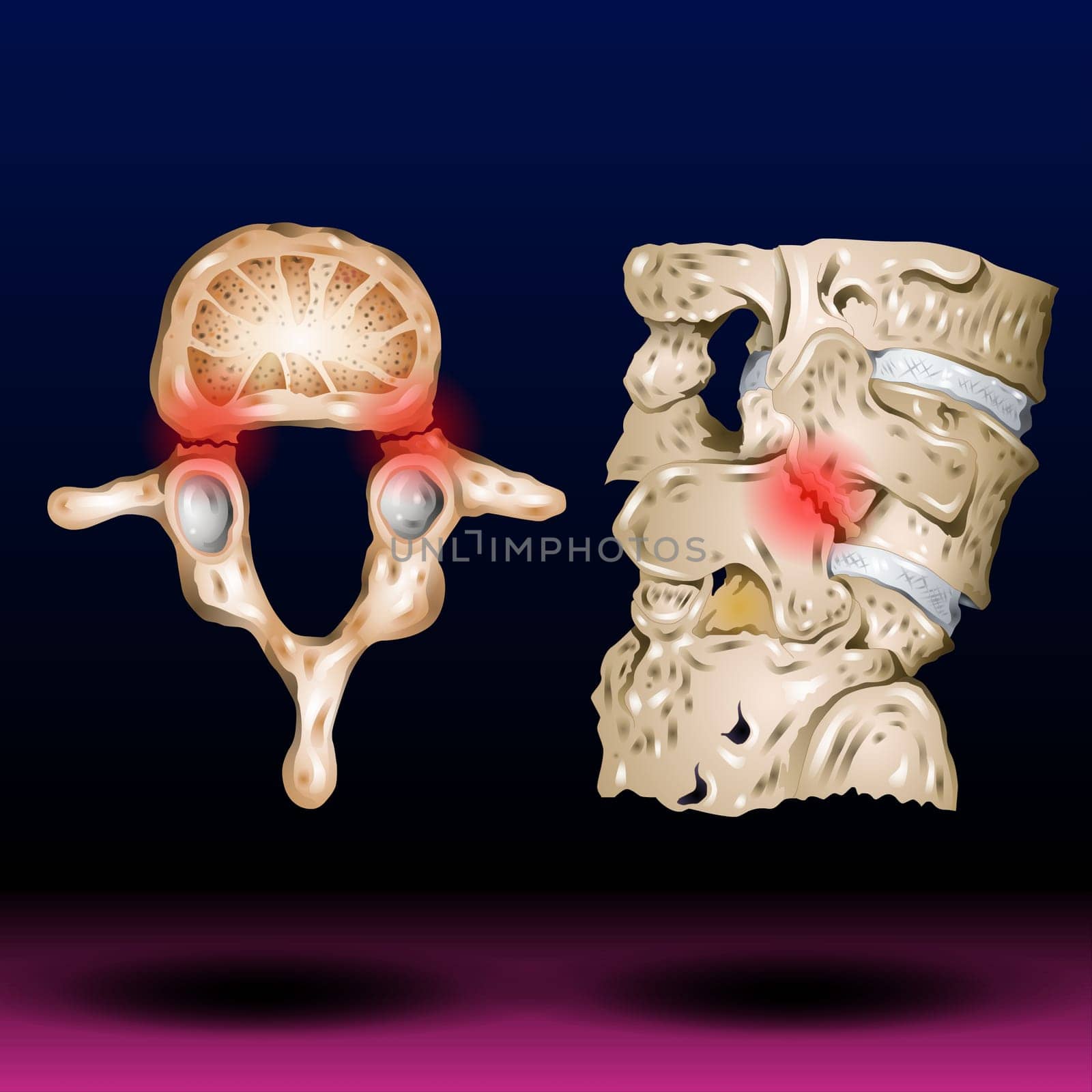 Spondylosis , Spondylolisthesis ( Film x-ray lumbo - sacral spine show spine collapse, decrease in disc space, bony spur formation ) ( side, lateral view ) and blank area