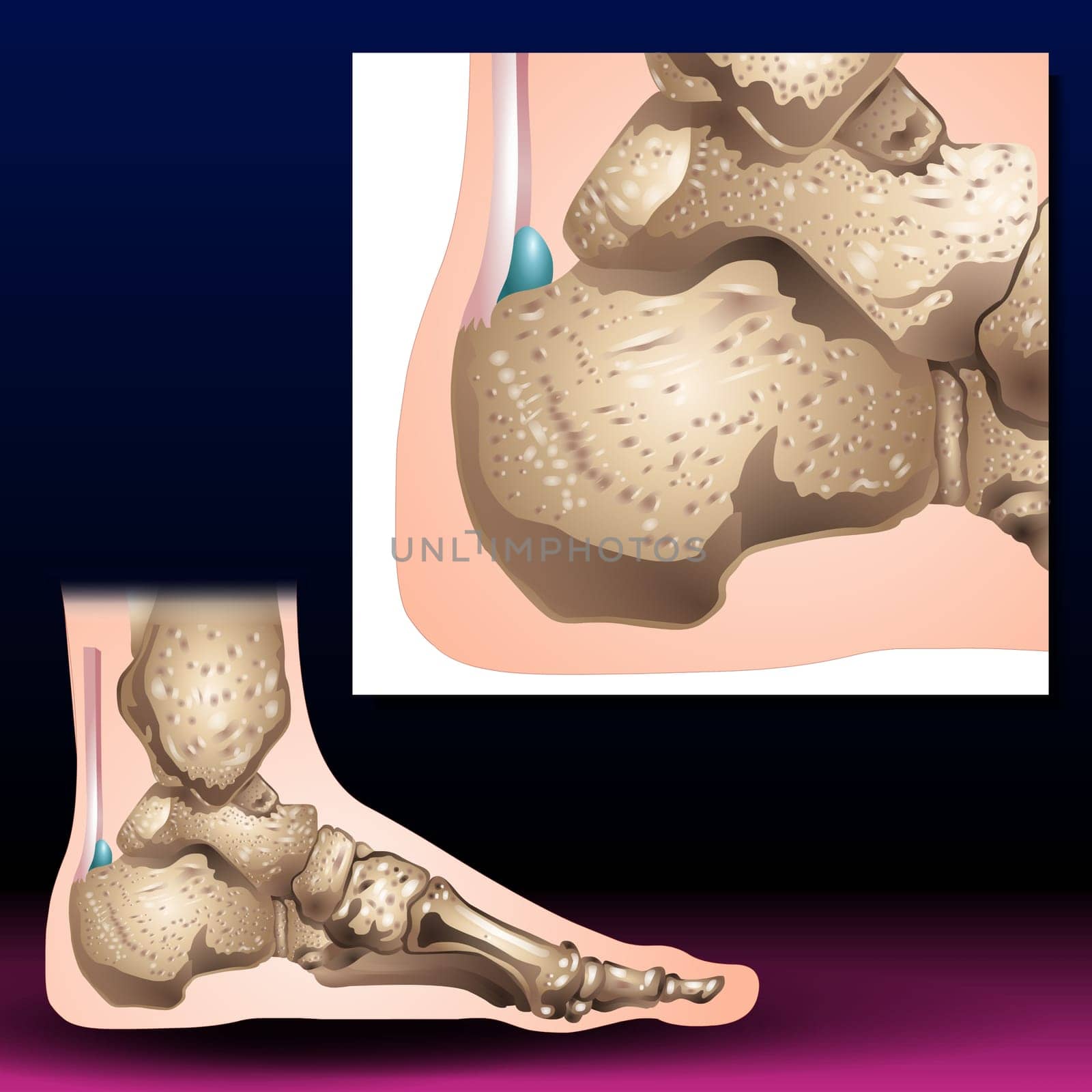 Fractures of the toes and forefoot are quite common. Fractures can result from a direct blow to the foot — such as accidentally kicking something hard or dropping a heavy object on your toes.
