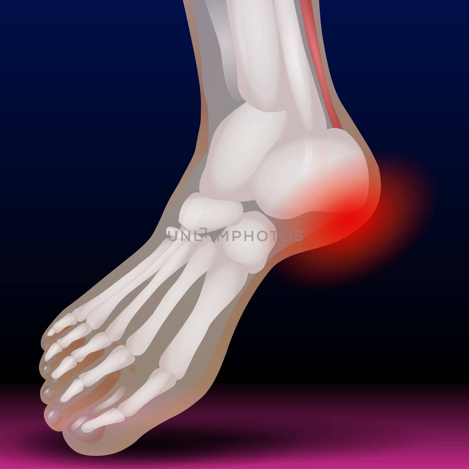 Fractures of the toes and forefoot are quite common. Fractures can result from a direct blow to the foot — such as accidentally kicking something hard or dropping a heavy object on your toes.