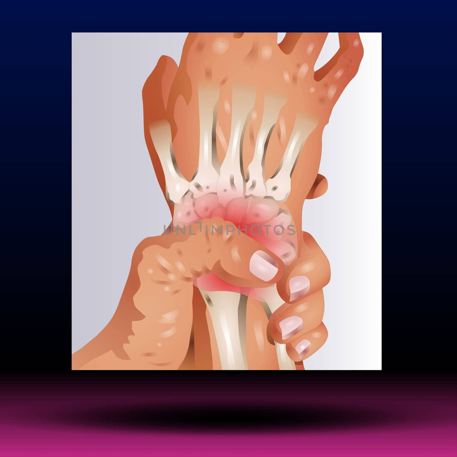 Wrist pain is often caused by sprains or fractures from sudden injuries. But wrist pain can also result from long-term problems, such as repetitive stress, arthritis and carpal tunnel syndrome.