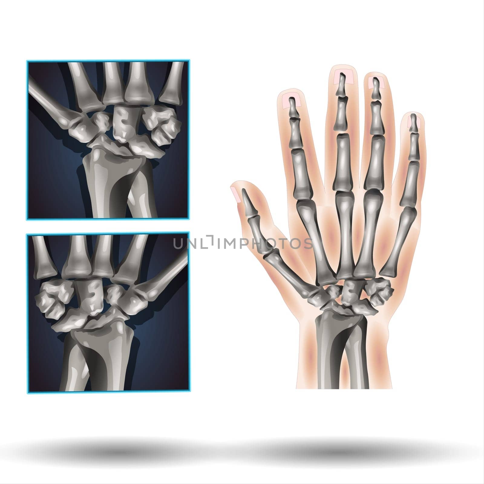 Carpal bones. Human hand anatomy. small bones of the wrist: Scaphoid, Lunate, Triquetrum, Pisiform, Trapezium, Trapezoid, Capitate and Hamate. Vector illustration