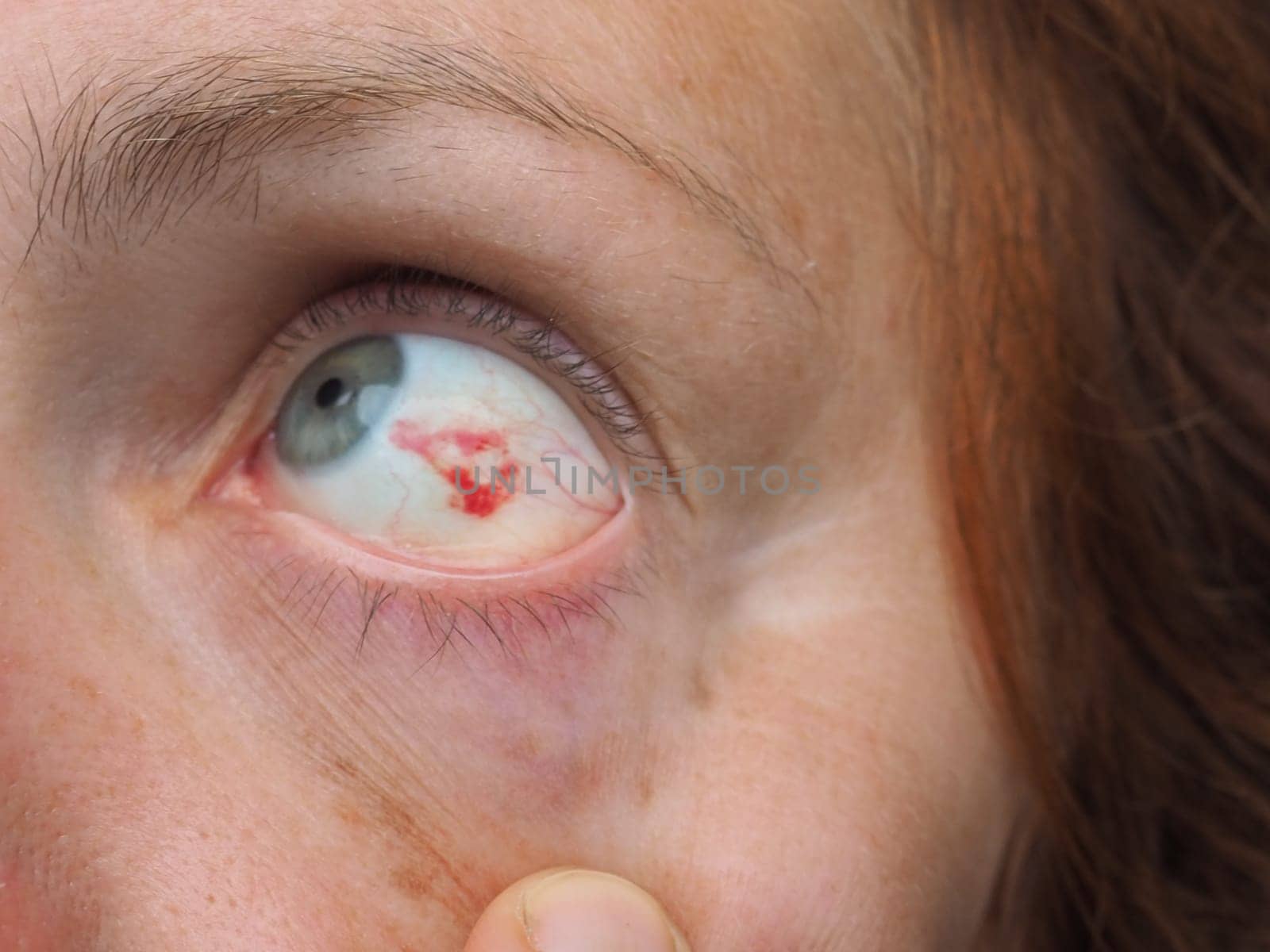 Subconjunctival hemorrhage or subconjunctival bleeding, hyposhagmus. Bleeding under the conjunctiva. Damaged blood vessels. Blood seeps into the space between the conjunctiva and sclera. Grey eyes