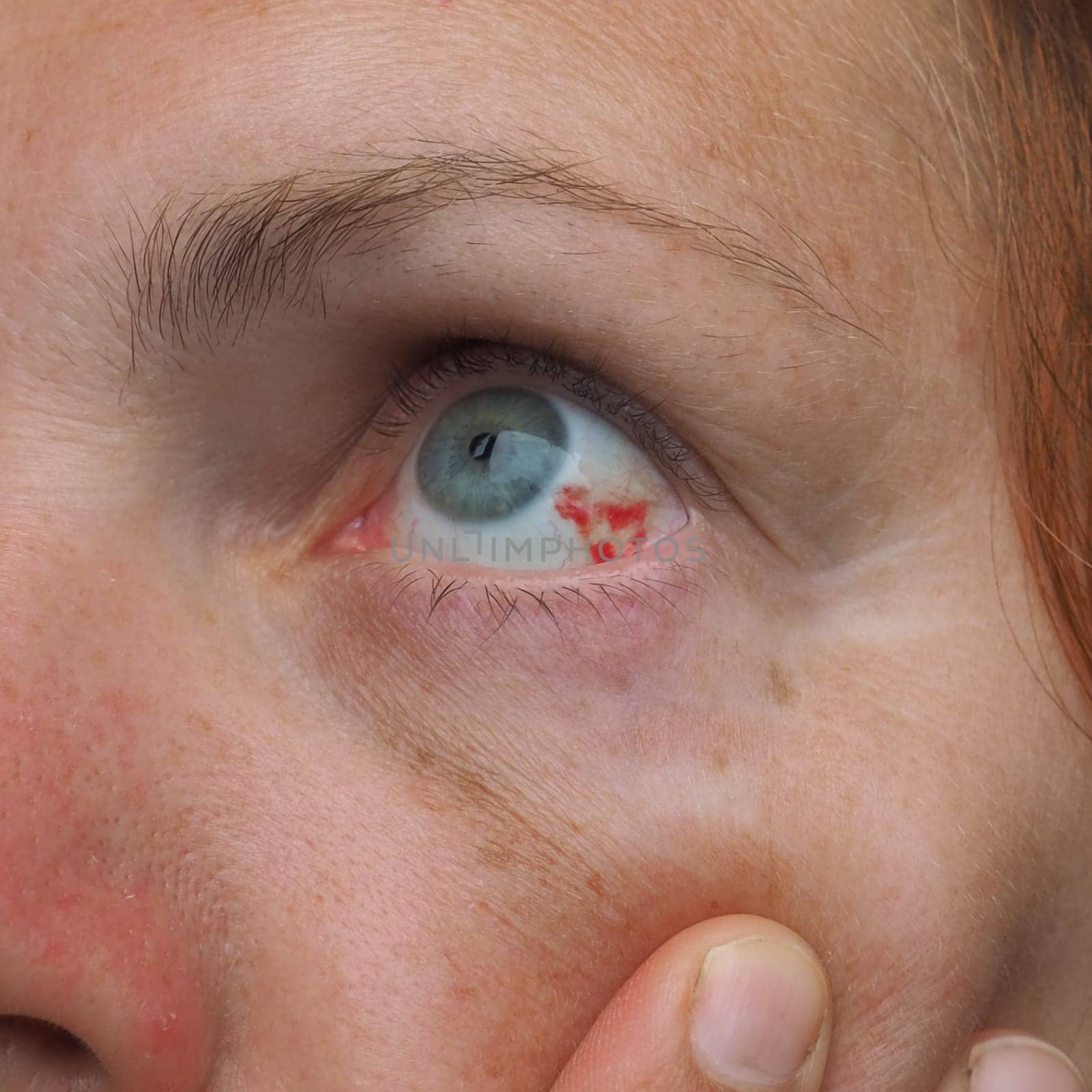 Subconjunctival hemorrhage or subconjunctival bleeding, hyposhagmus. Bleeding under the conjunctiva. Damaged blood vessels. Blood seeps into the space between the conjunctiva and sclera. Grey eyes