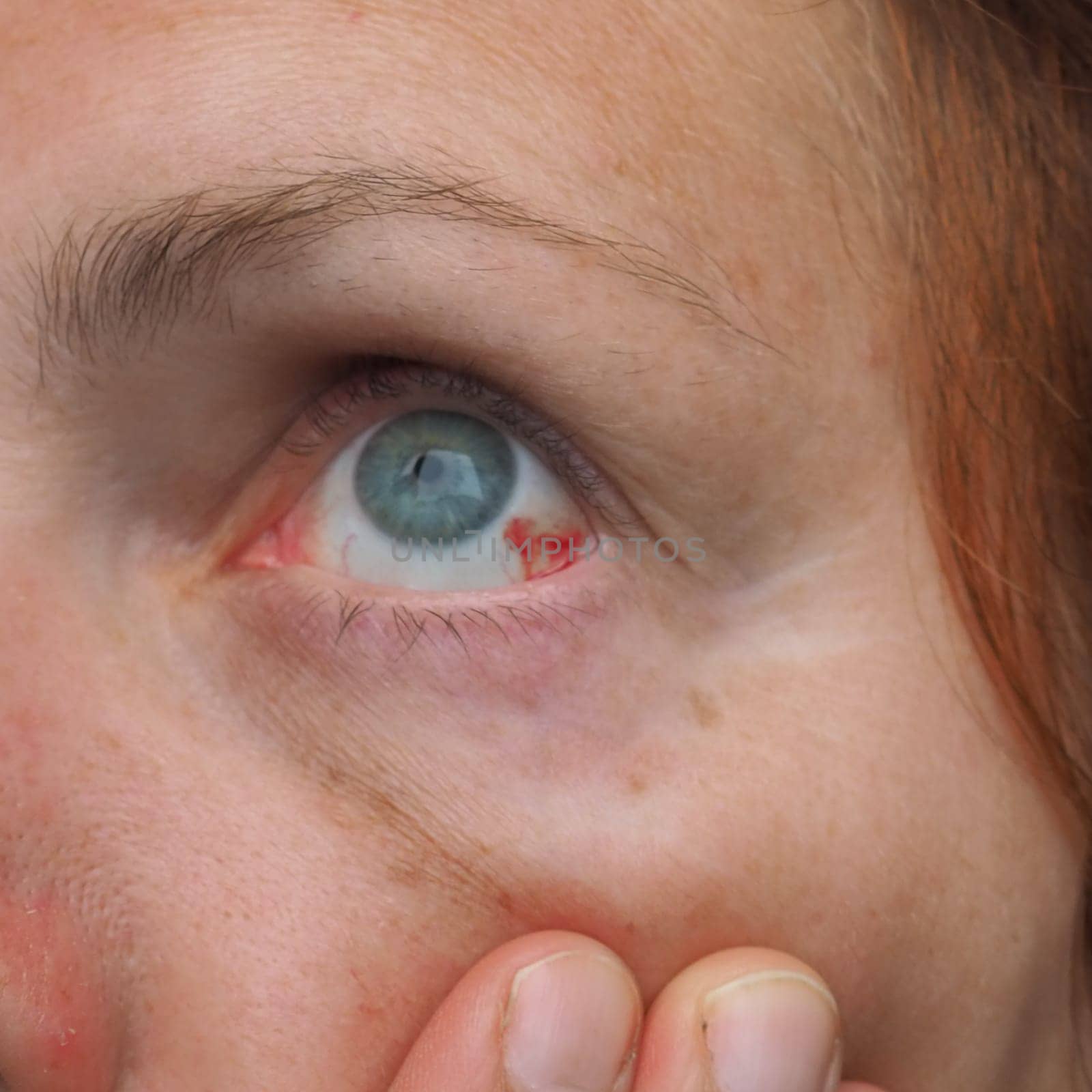 Subconjunctival hemorrhage or subconjunctival bleeding, hyposhagmus. Bleeding under the conjunctiva. Damaged blood vessels. Blood seeps into the space between the conjunctiva and sclera. Grey eyes