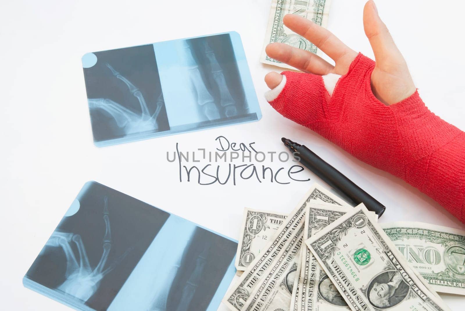Bandaged arm, xray prints, dollar bills and pen. Hand is bandaged in red plaster and splint in oreder to support the healing process.