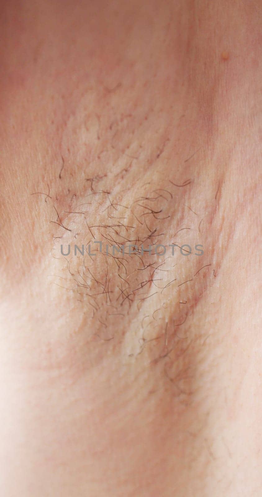 Young Woman With Hairy Armpit. Hair Removal And Shaving