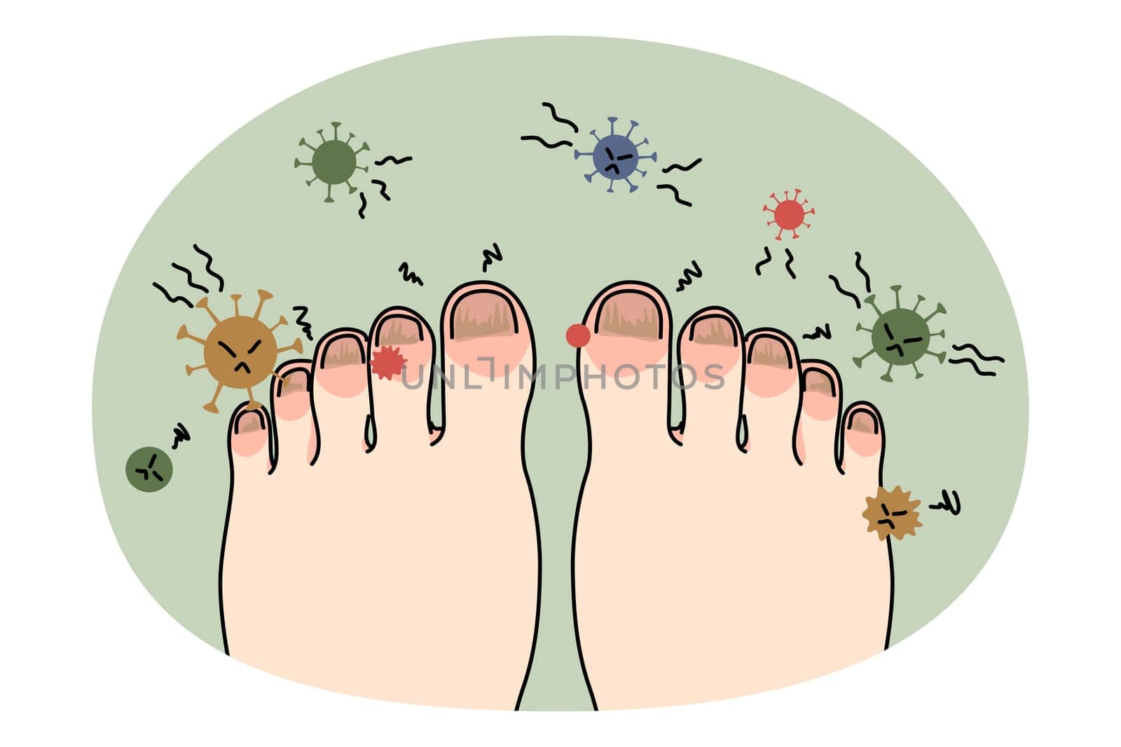 Person feet with nail disease or infection. Foot with onychomycosis or fungus on fingers. Medical treatment and procedure. Healthcare and medicine concept. Flat vector illustration.