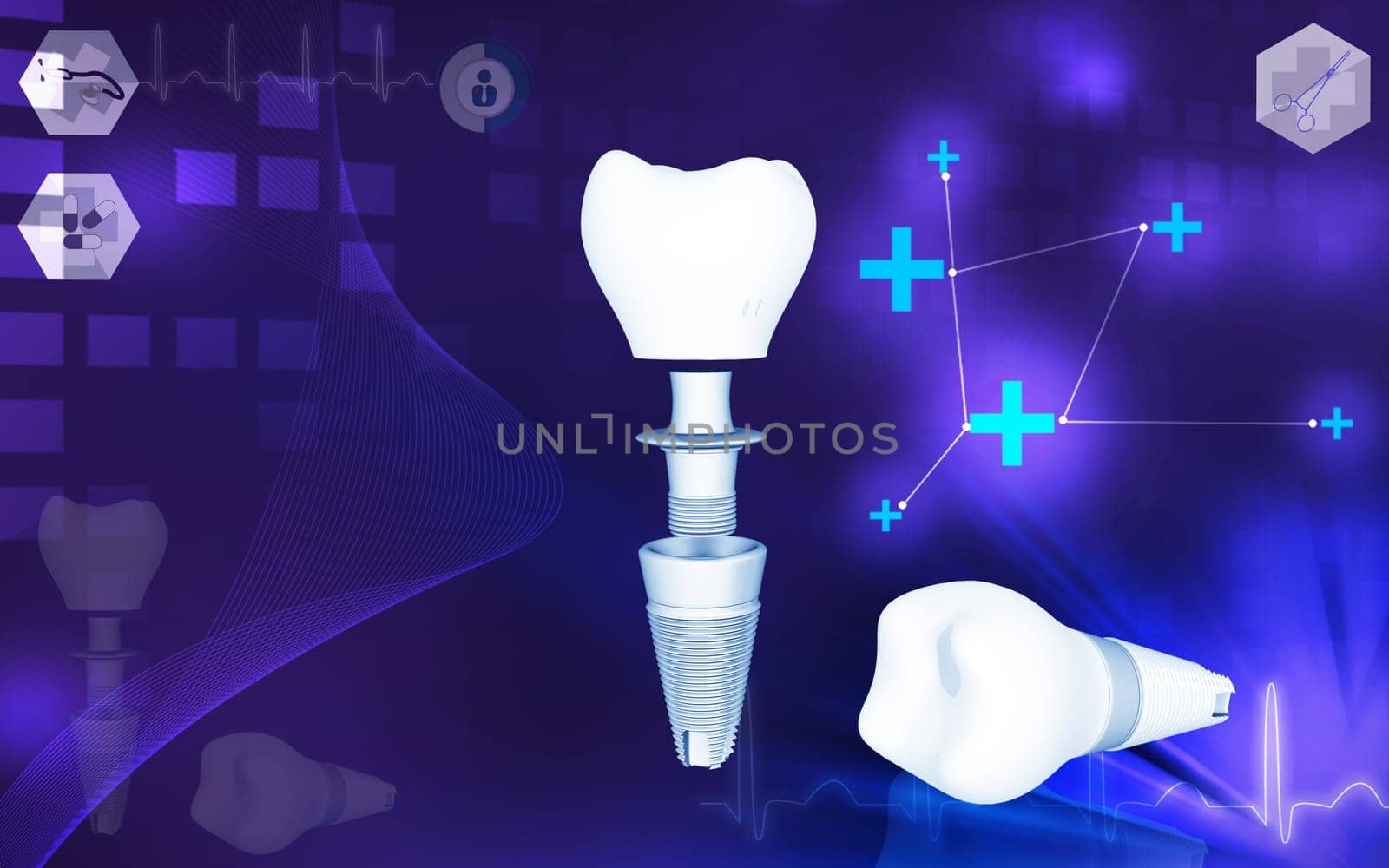 Digital illustration of Dental implant in colour background