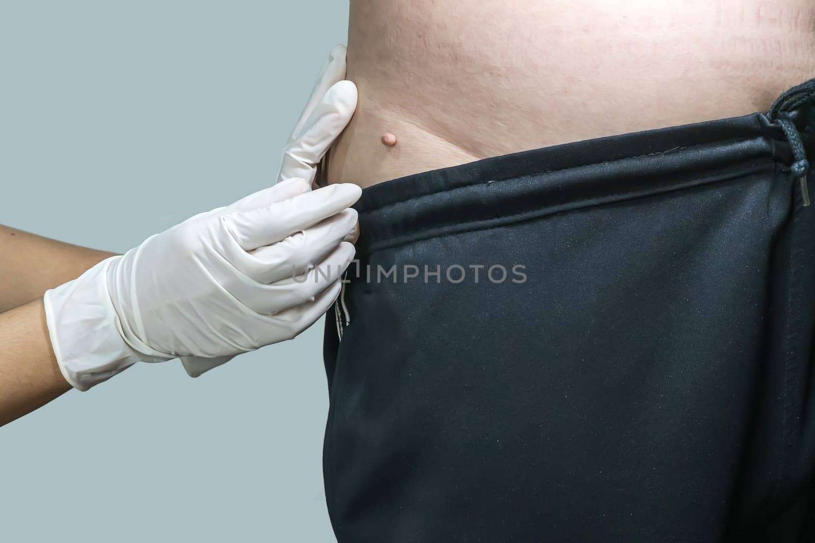 Skin tag or acrochondon or soft fibroma is a safe. It have not effect to the body. It usually occurs at neck, face, armpits and body.