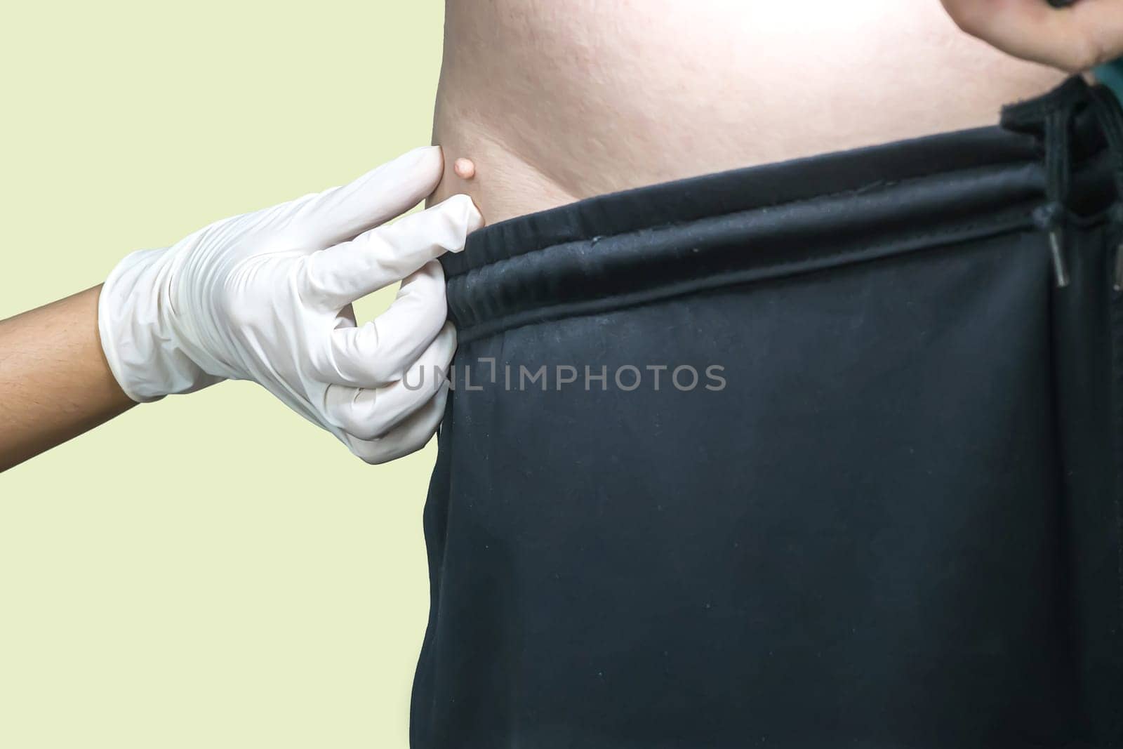 Skin tag or acrochondon or soft fibroma is a safe. It have not effect to the body. It usually occurs at neck, face, armpits and body.
