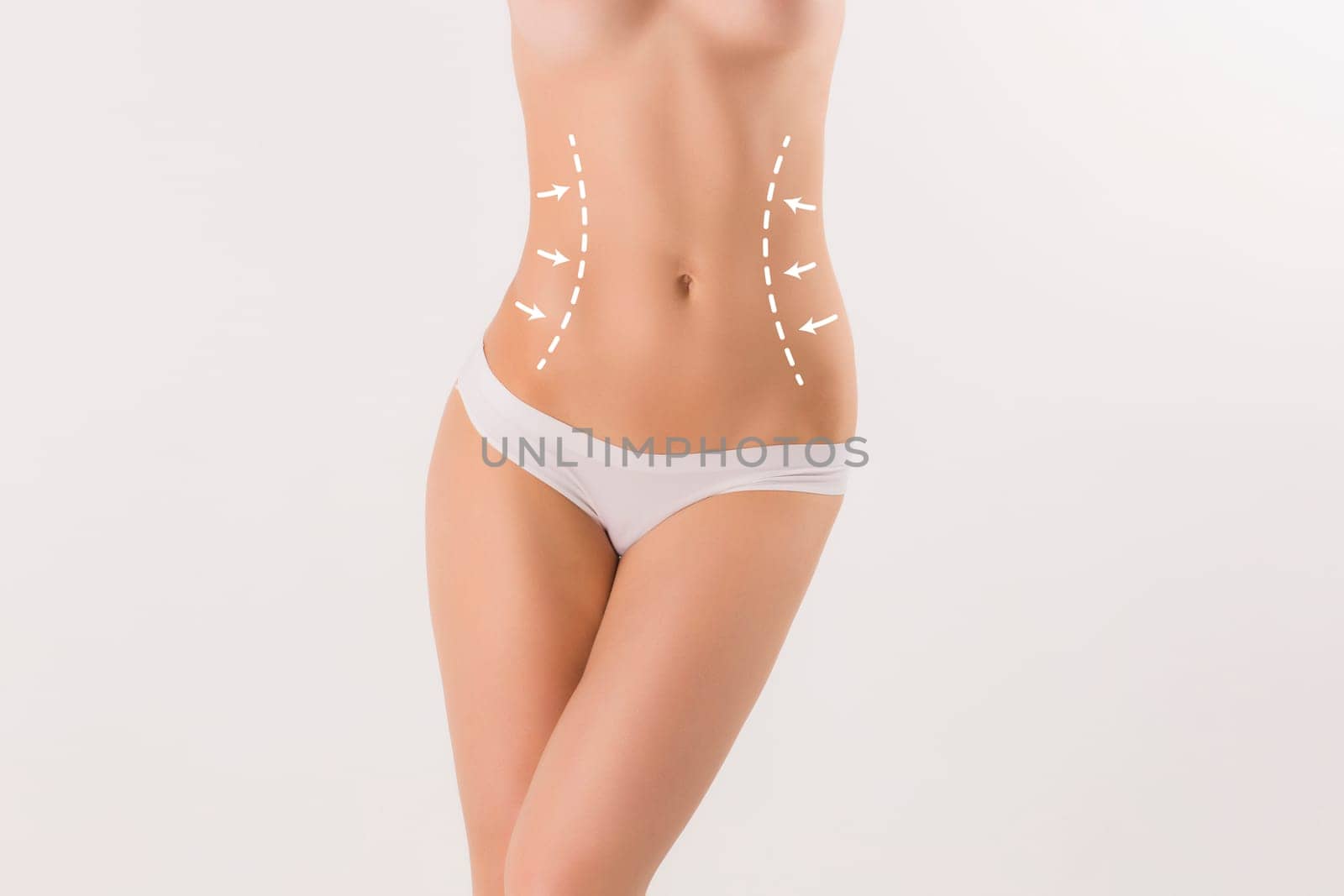 Body correction with the help of plastic surgery on  white background. Woman belly marked out for cosmetic surgery or liposuction