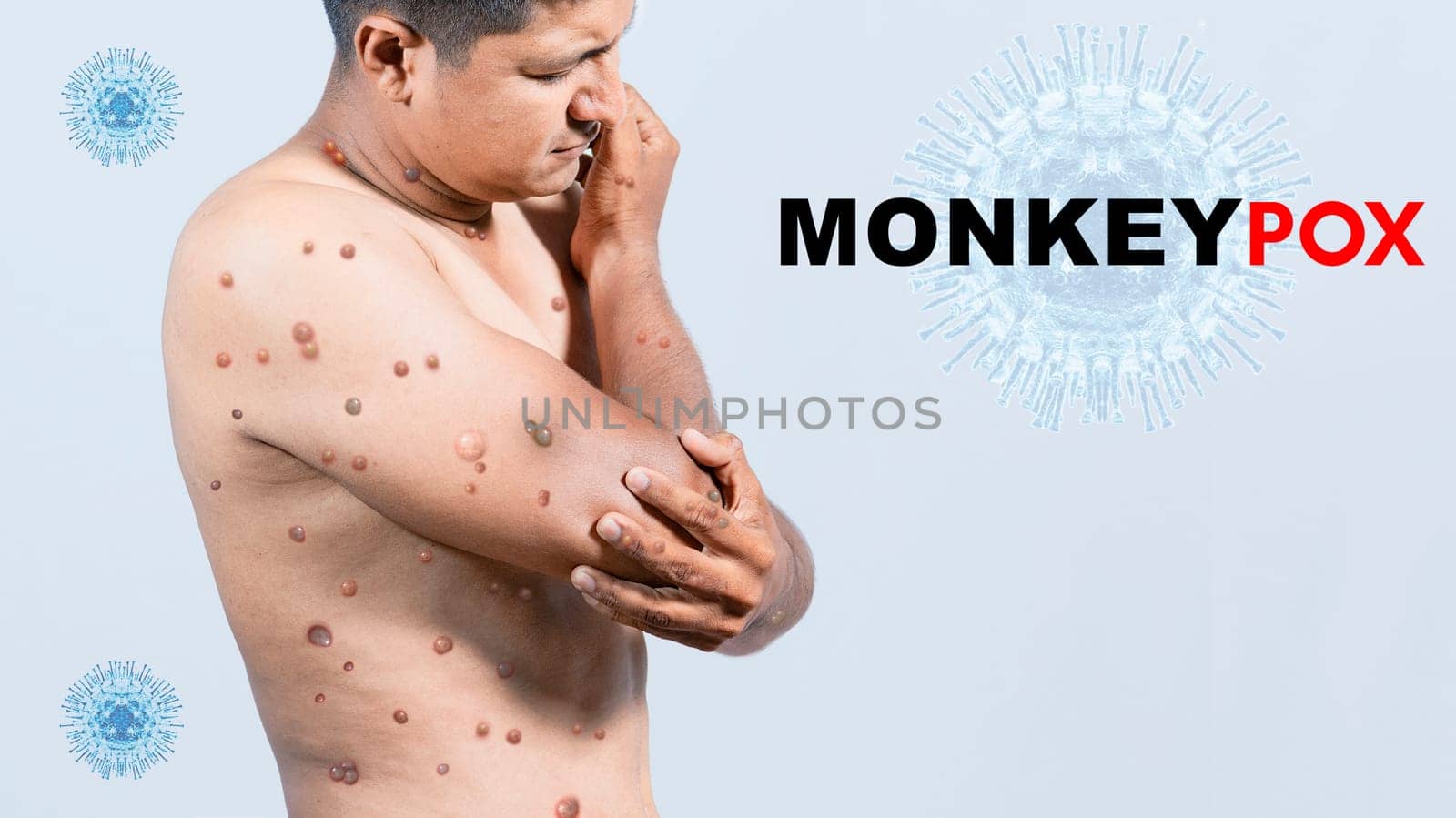 A person with monkeypox on his body, People with monkeypox on isolated background, monkeypox virus concept, monkeypox virus outbreak pandemic design
