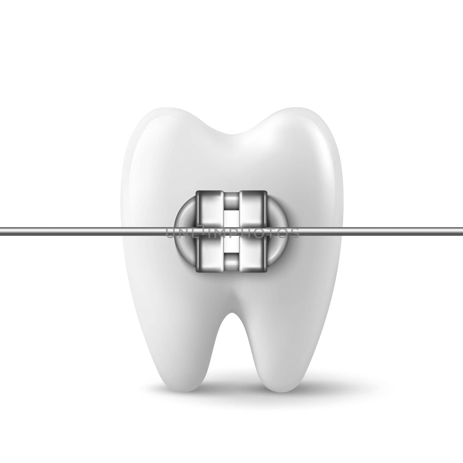 Vector 3d Realistic Tooth with Braces Icon Closeup Isolated on White Background. Medical Dentist Design Template, Clipart. Dental Health Concept.
