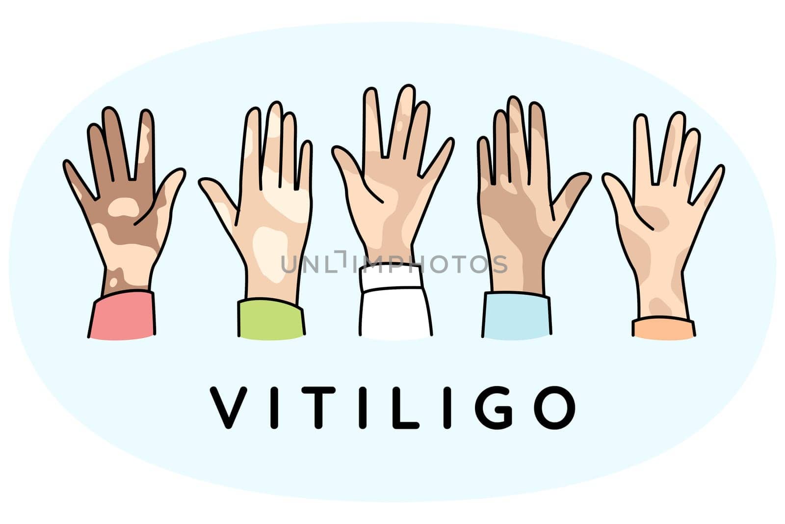 Diverse hands of people suffer from vitiligo disease. People struggle with pigmentation on body. World vitiligo day concept. Vector illustration.