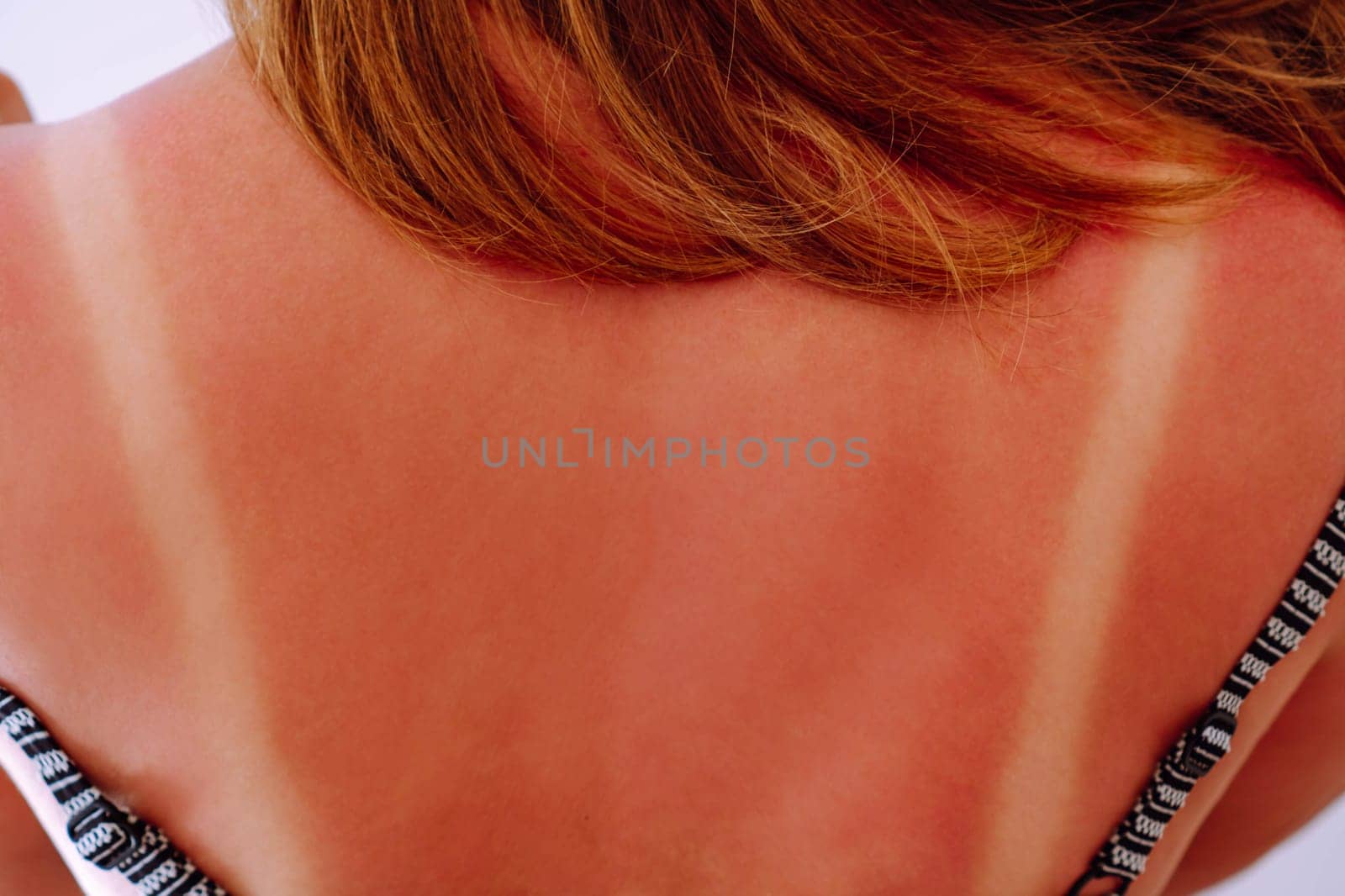 Back view of young woman with light traces of swimsuit on sunburnt naked back on blue background. Summer, UV protection, health, cosmetology, dermatology, sunbathing, sun block, tanning, skincare.