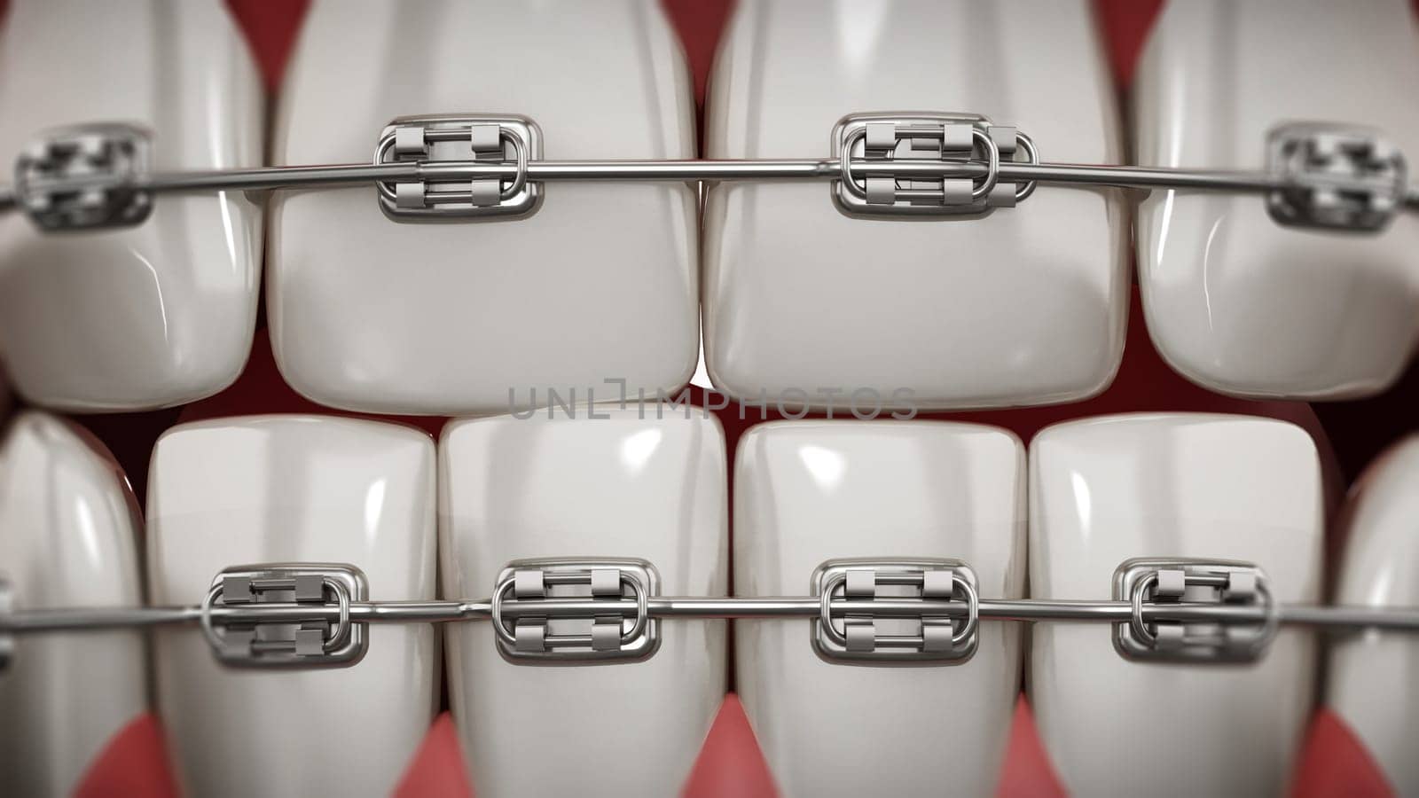 Illustration showing dental braces on straight teeth. 3D illustration.