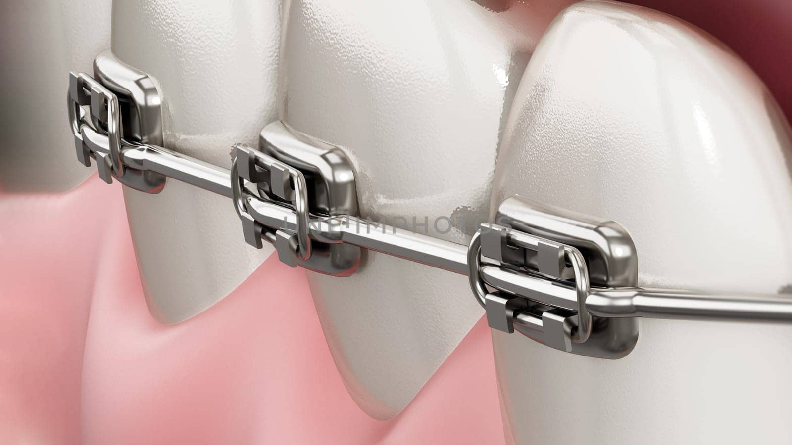 Illustration showing dental braces on straight teeth. 3D illustration.