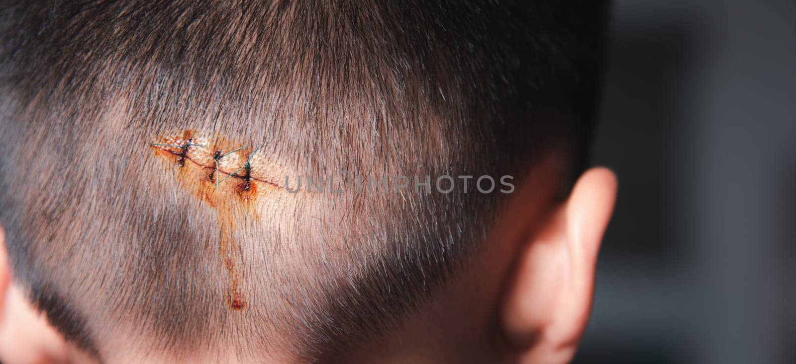 The lacerated sutured wound of kid back head which suture by nylon suture about 3 stitches at the emergency room of the hospital, Medical care of the surgery lesion on the head, children of Accident