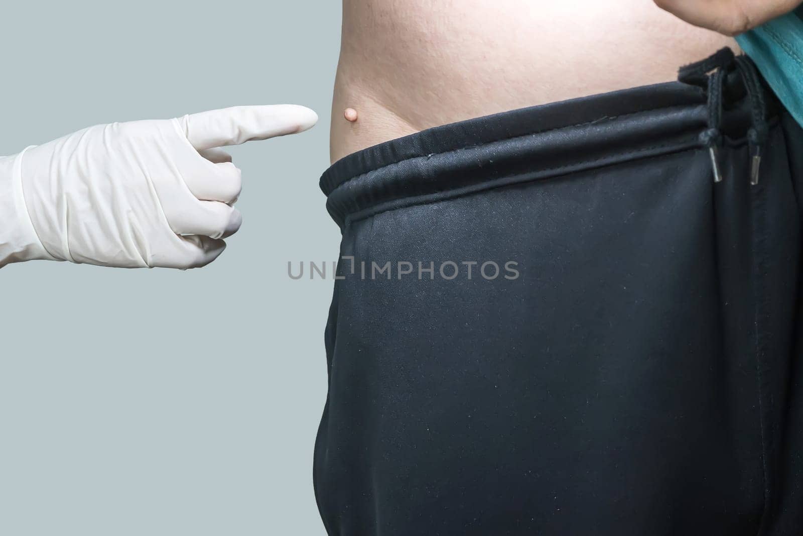 Skin tag or acrochondon or soft fibroma is a safe. It have not effect to the body. It usually occurs at neck, face, armpits and body.