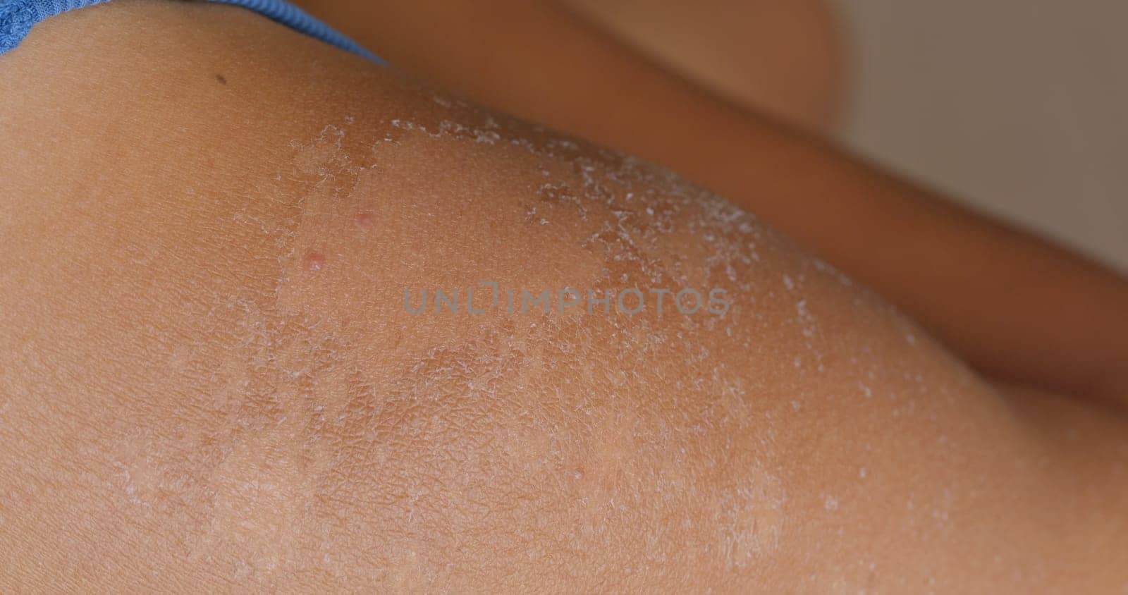 Sunburned skin, peeling skin from a sunburn