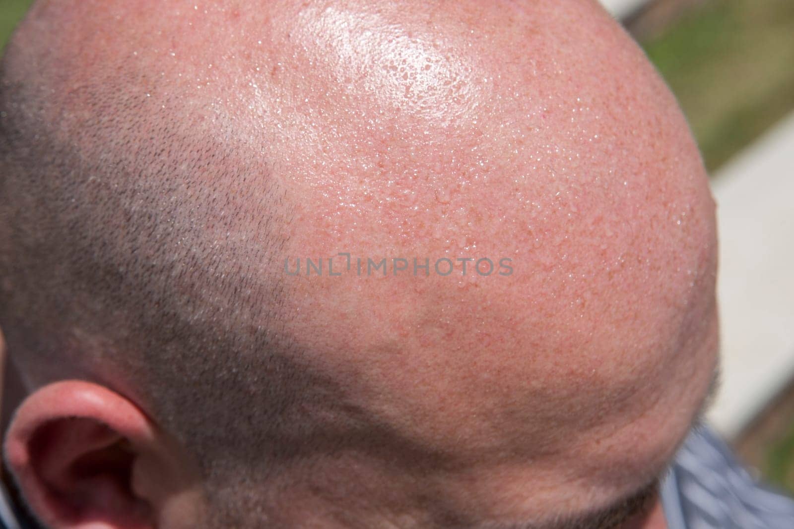 Bald man with unprotected head receiving the summer sun. Selective focus