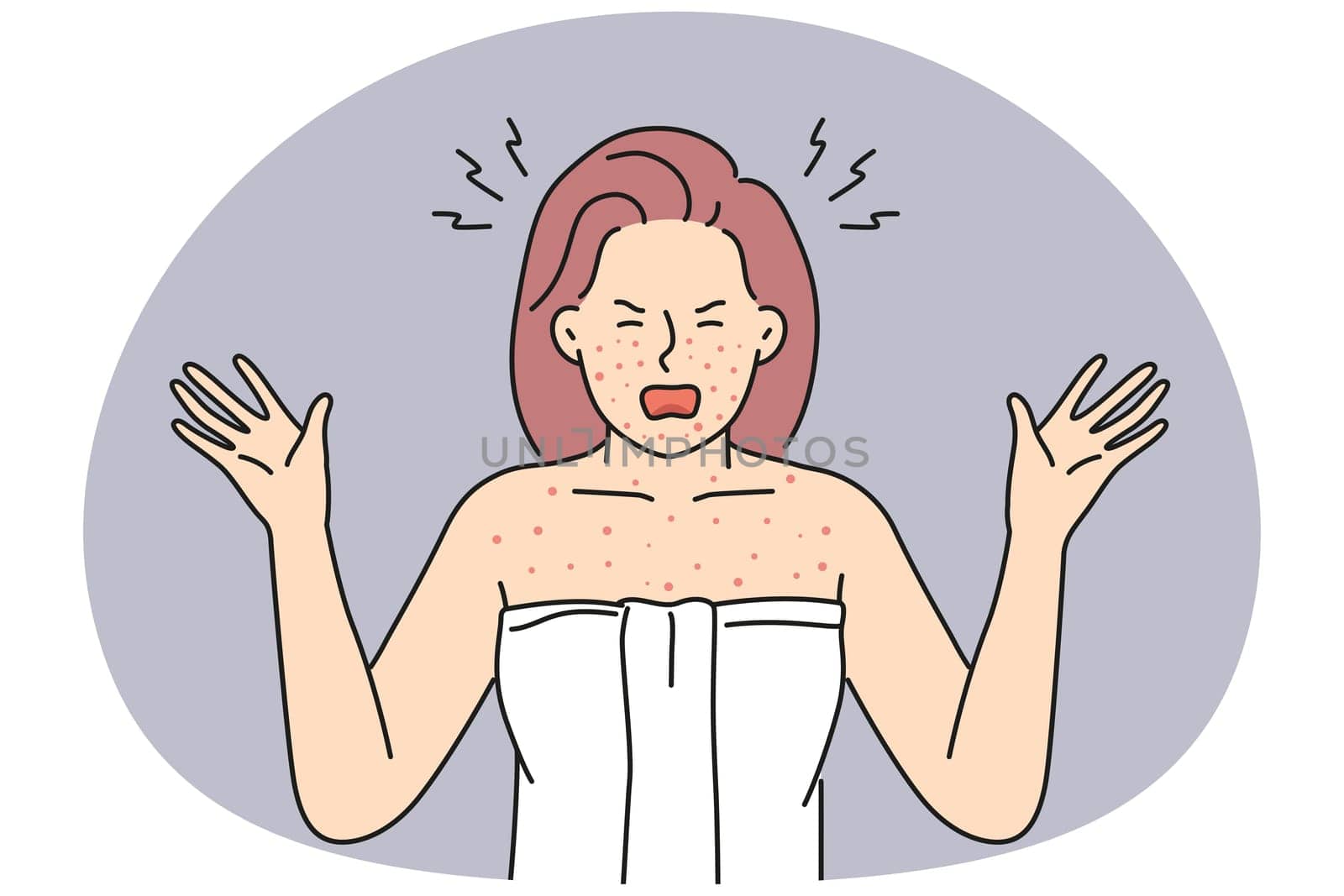Angry woman in towel shout distressed with red body inflammation. Furious female anxious with allergy reaction or dermatitis. Vector illustration.