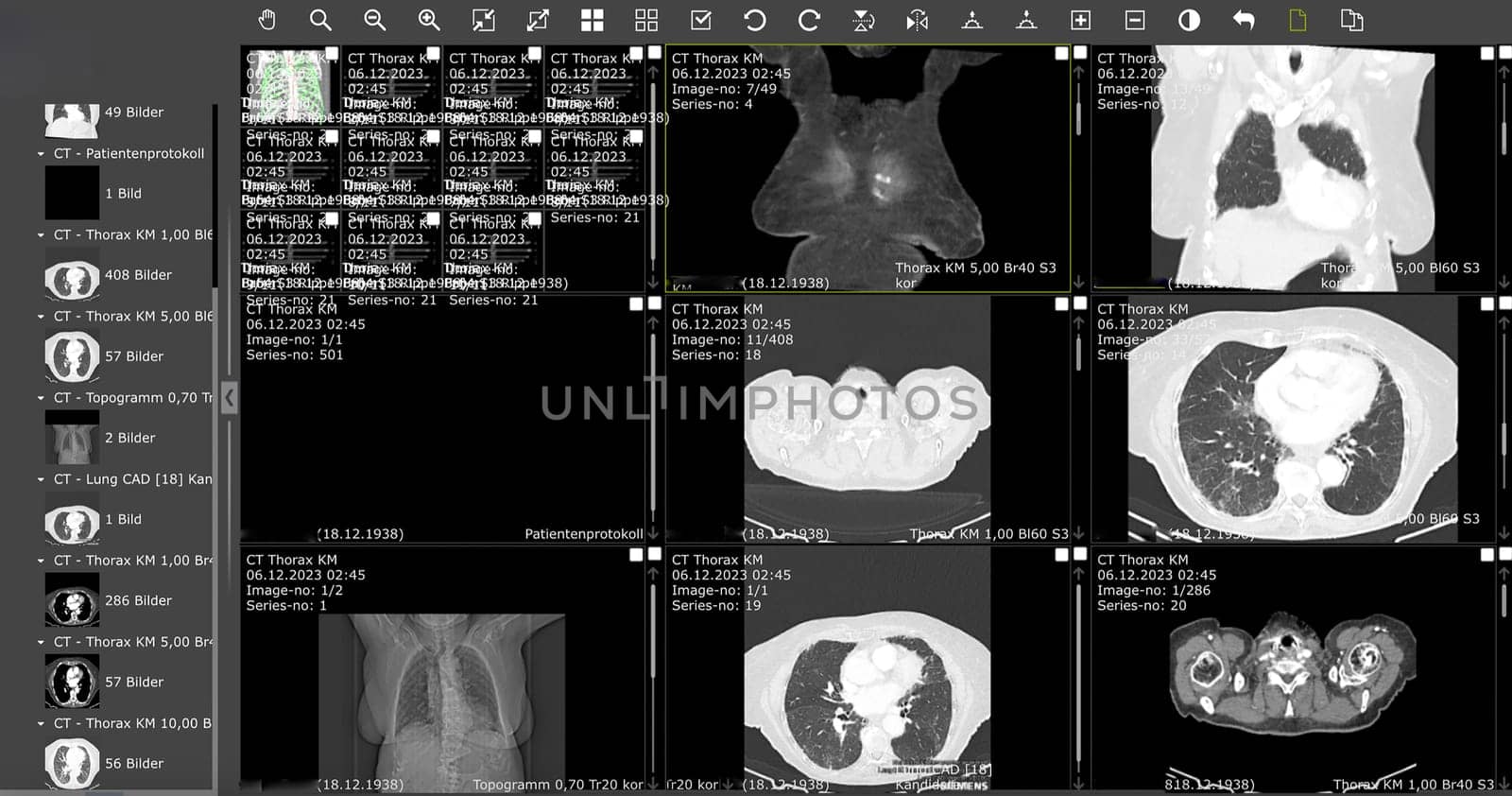 Frankfurt, Germany - January 28, 2024: computed Tomography of a lung with illness fibrosis