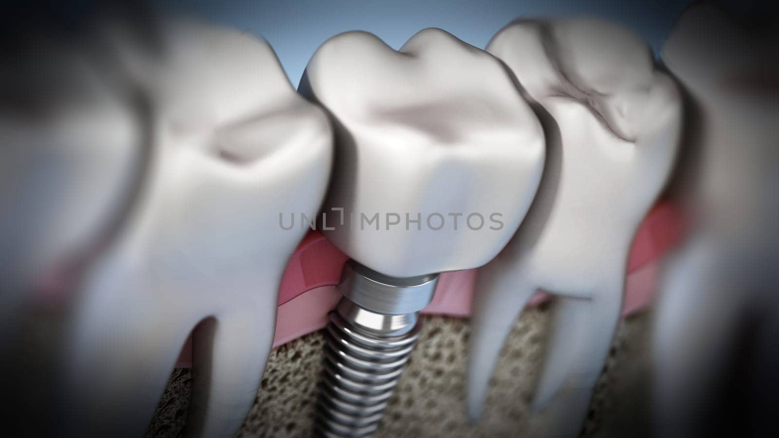 3D rendering of tooth implant showing jaw gum and bone layers. 3D illustration.