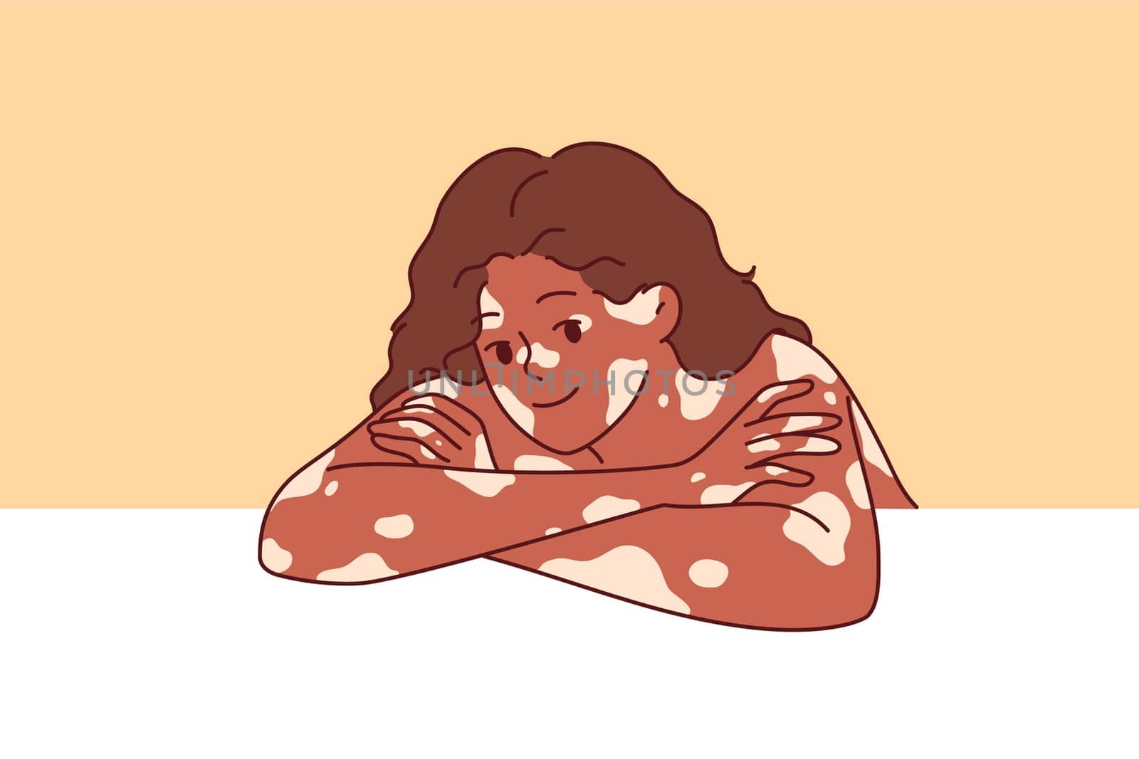 African American woman with vitiligo syndrome and spots on skin smiles, leaning elbows on white surface. Beautiful vitiligo girl calls for attention to dermatological problems caused by pigmentation