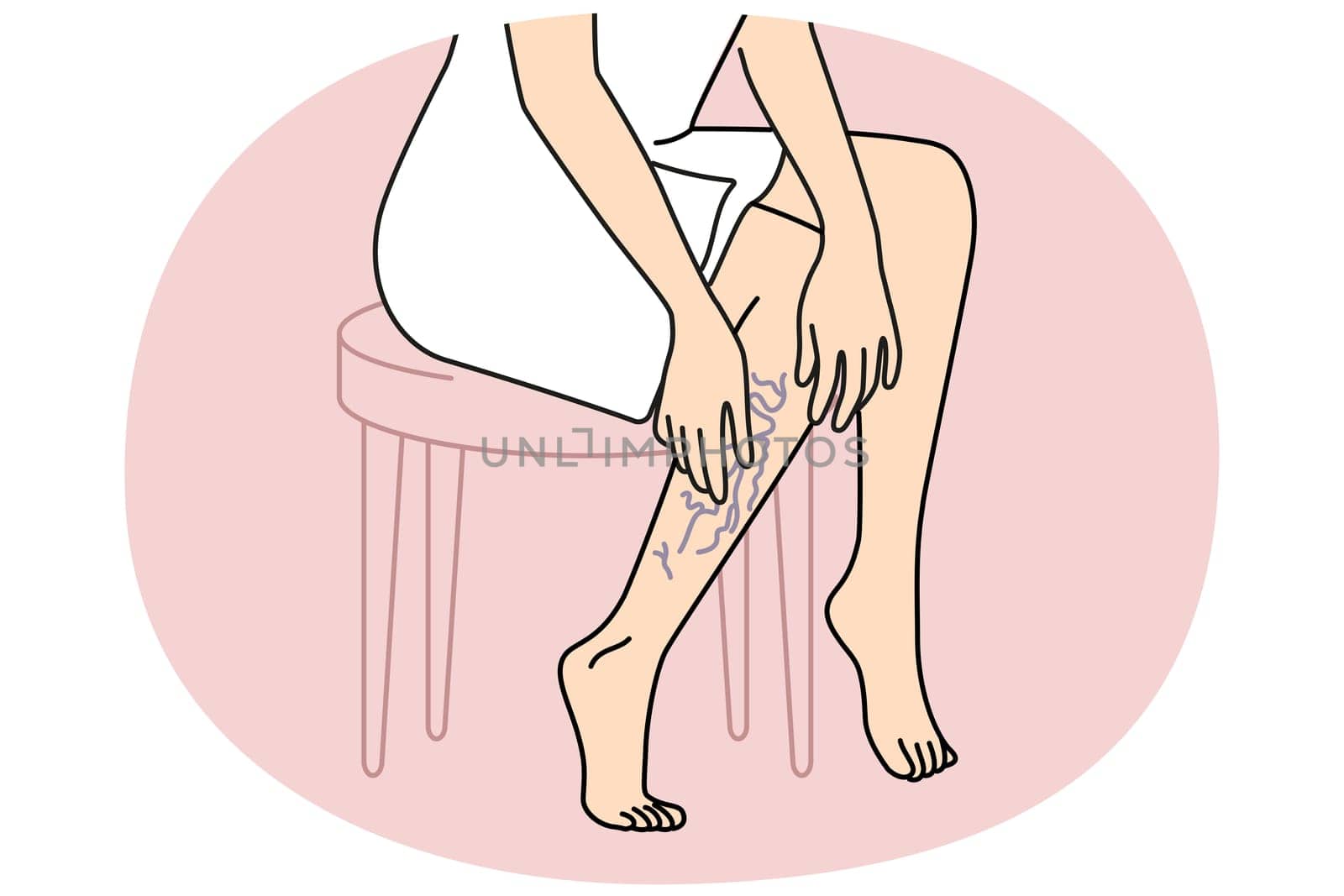 Woman touching legs with varicose veins. Female with vascular leg disease suffer from enlarged blood vessels. Vector illustration.