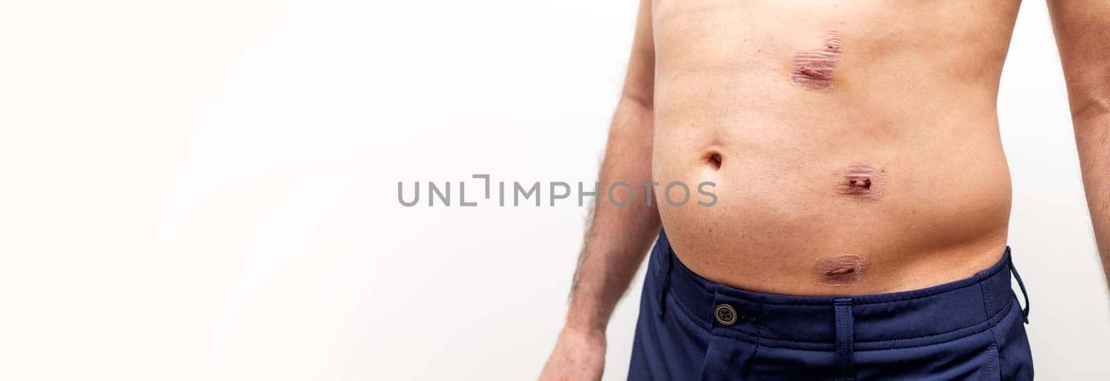 Banner Laparoscopic Appendectomy Surgery. Three Scars in Abdomen Area. Horizontal Copy Space. Surgical Marks from Abdominal Procedure, Medical Operation. Trauma and Emergency Appendicitis High quality