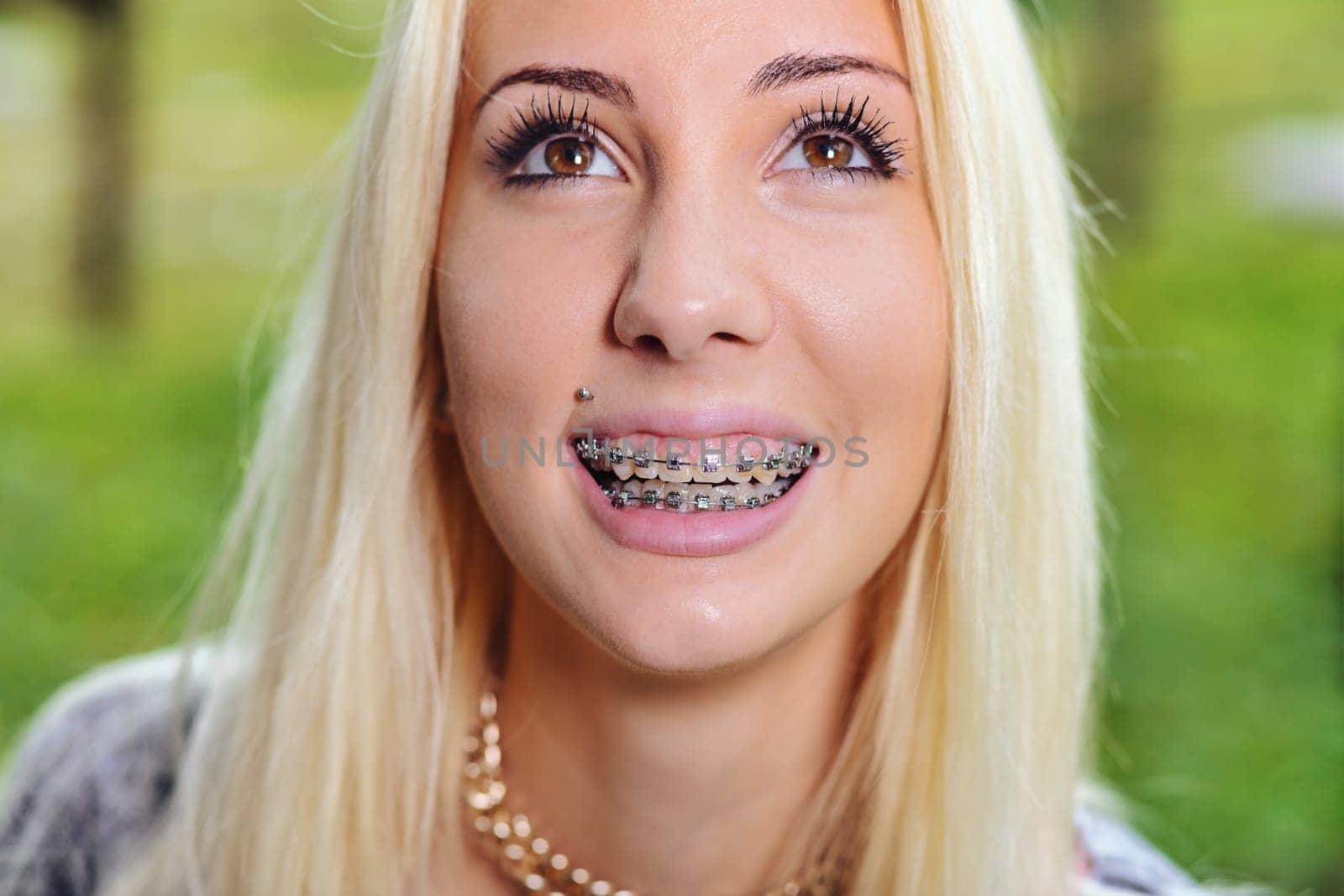 In this portrait of a smiling girl, the two rows of teeth with braces are perfectly visible. She is looking up beyond the lens and the braces are the main subject. She has a piercing above her lip.