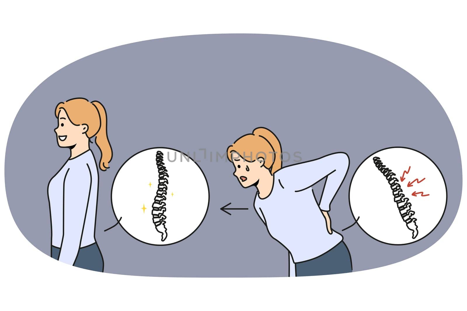 Woman with sick spine near healthy girl with good posture who underwent chiropractic procedure. Concept of spinal injury and need for therapeutic massage from osteopathy or chiropractic doctor