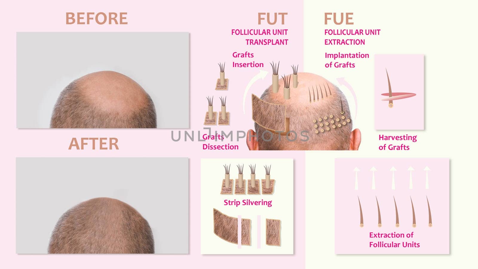 Methods of hair transplantation FUT and FUE fue with transplant as infographic element of illustration. Human alopecia or hair loss problem on adult senior or mature man. Before and after concept