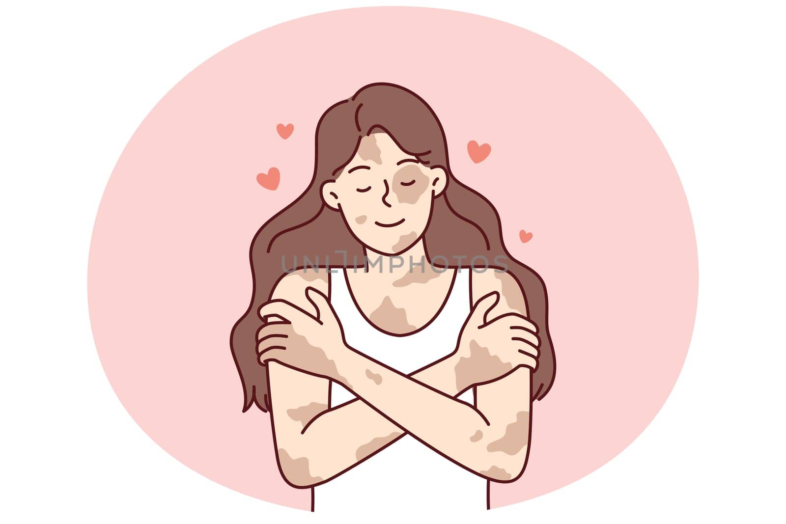 Positive girl with vitiligo disease hugging herself taking skin diseases as personal feature. Concepts of body positivity in people suffering from dermatological illness or vitiligo syndrome