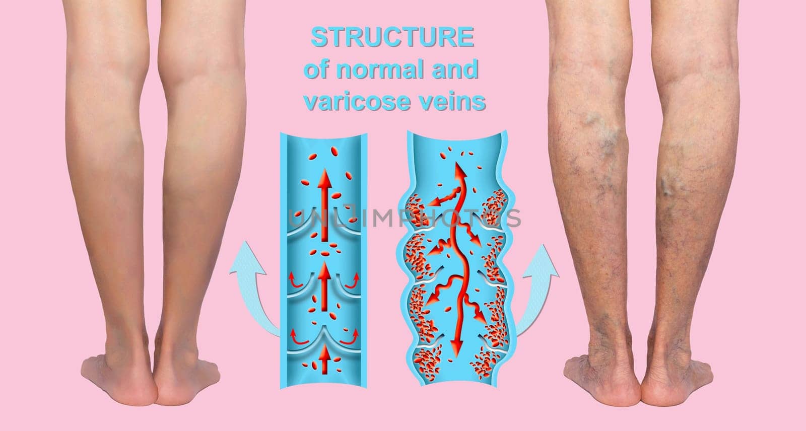 Varicose veins on a female senior legs. The structure of normal and varicose veins. Concept of dry skin, old senior people, varicose veins and deep vein thrombosis or DVT