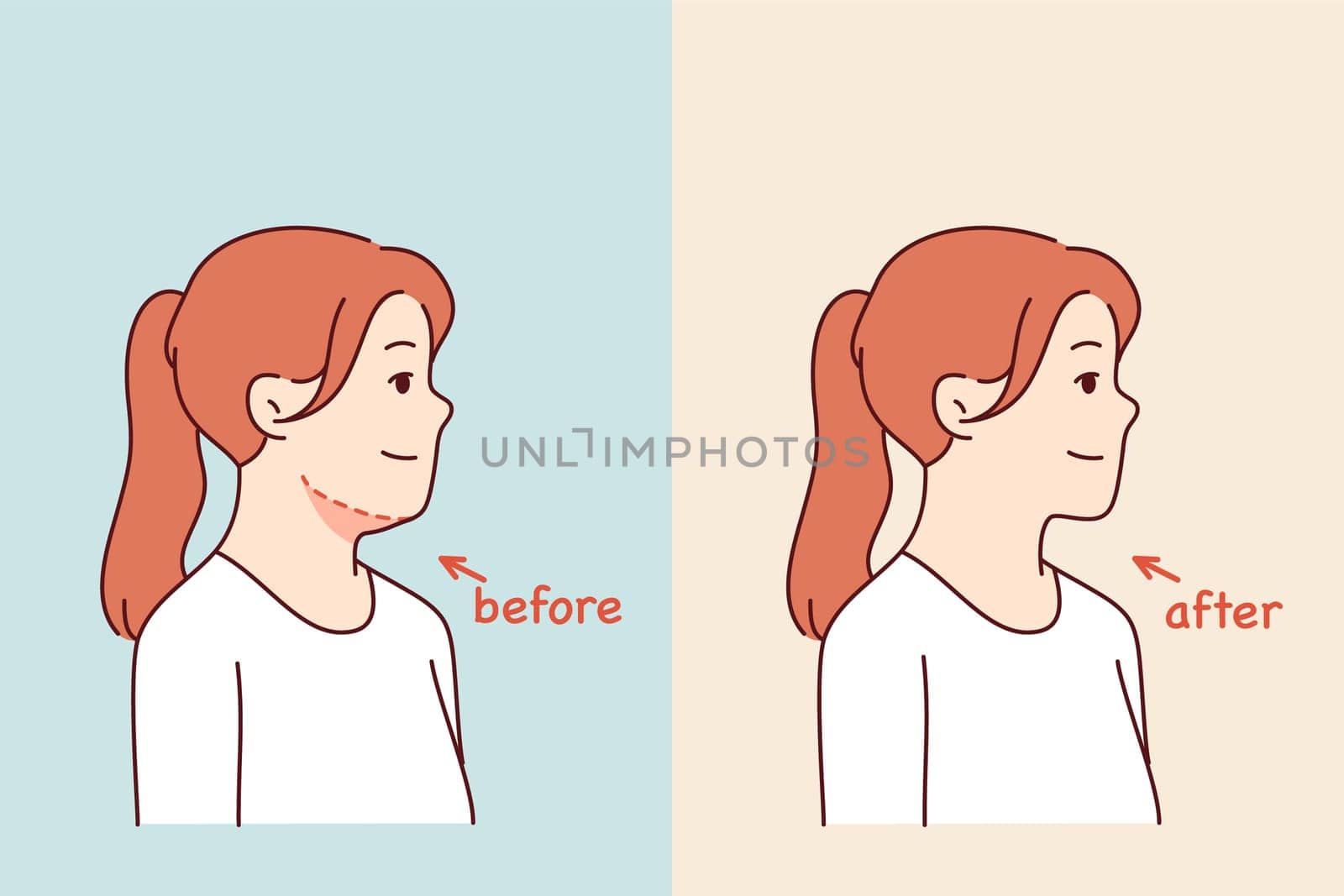 Double chin removal surgery for young girl posing before and after procedure with cosmetologist. Losing excess weight caused woman to get rid of double chin and increase attractiveness.