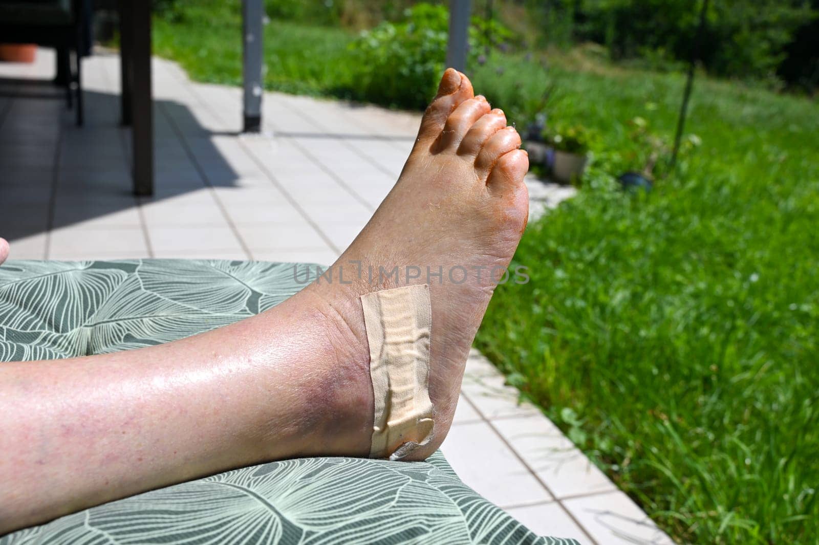 Foot raised on a terrace after an operation for a heel bone fracture, scar covered with a plaster