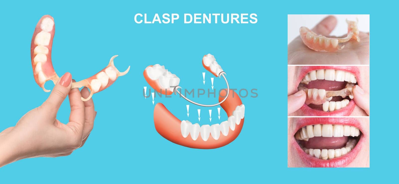 flexible nylon denture on female hand. Removable dentures flexible, devoid of nylon, hypoallergenic exempt from monomer