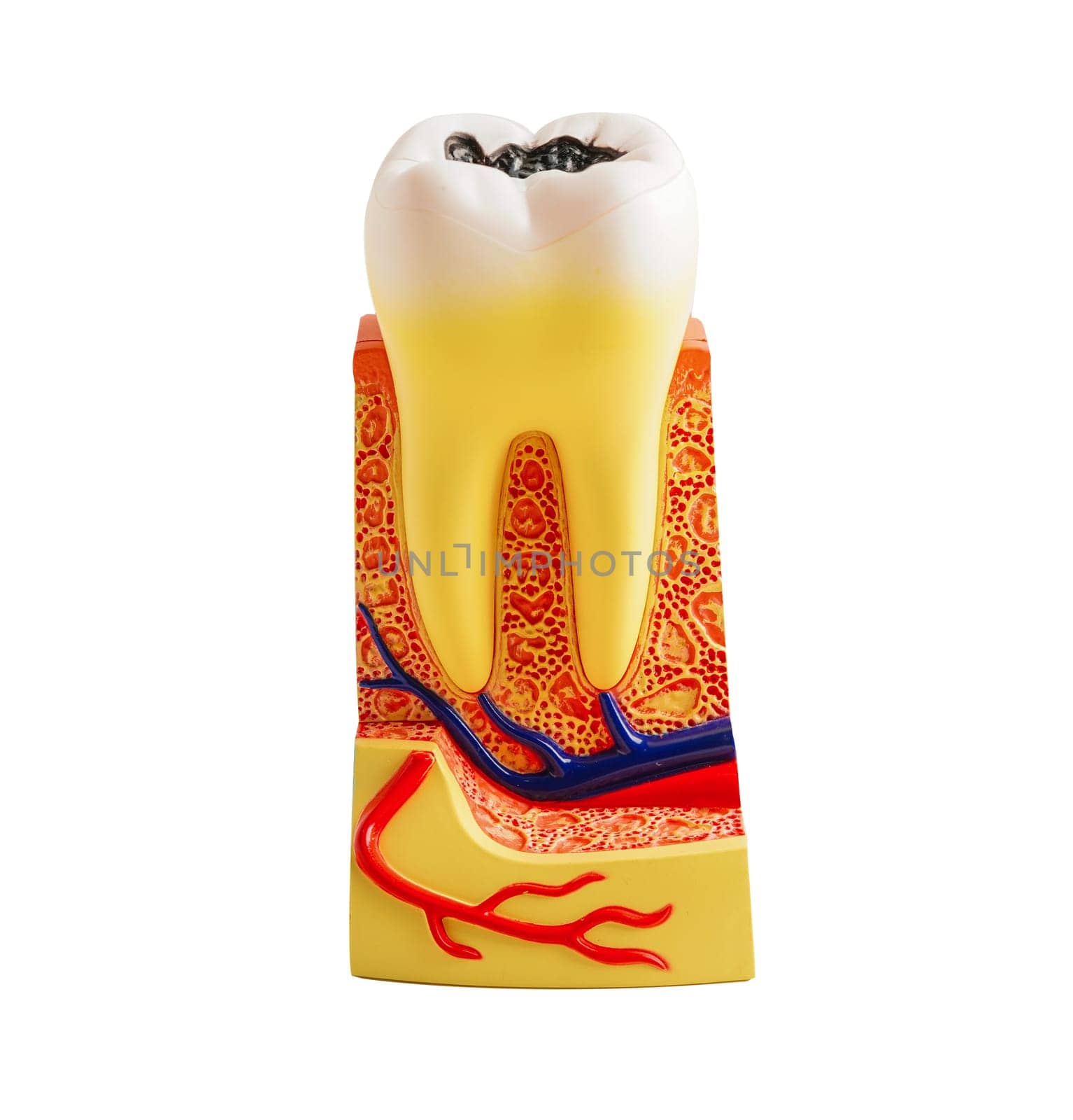 Decay tooth replace with dental implant root canal teeth model for education isolated on white background with clipping path.