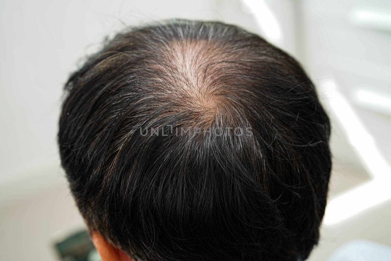Bald head in man, hair loss treatment health problem.