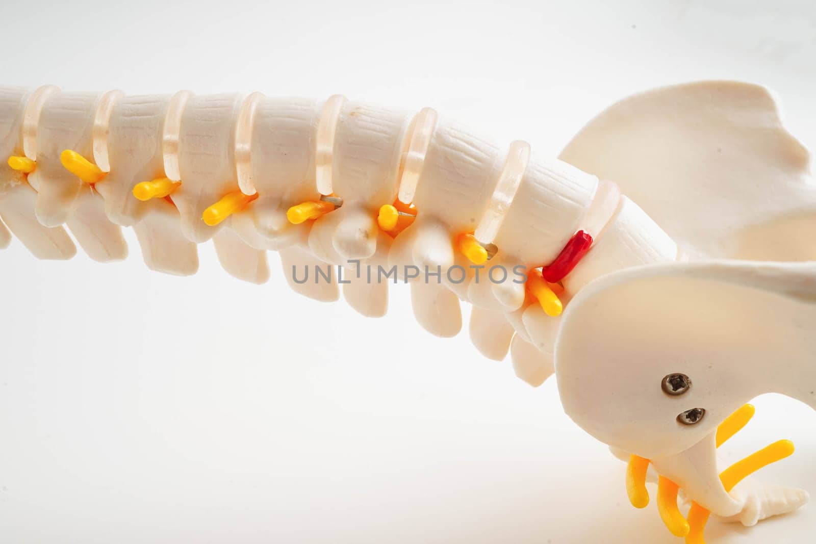 Spinal nerve and bone, Lumbar spine displaced herniated disc fragment, Model for treatment medical in the orthopedic department.