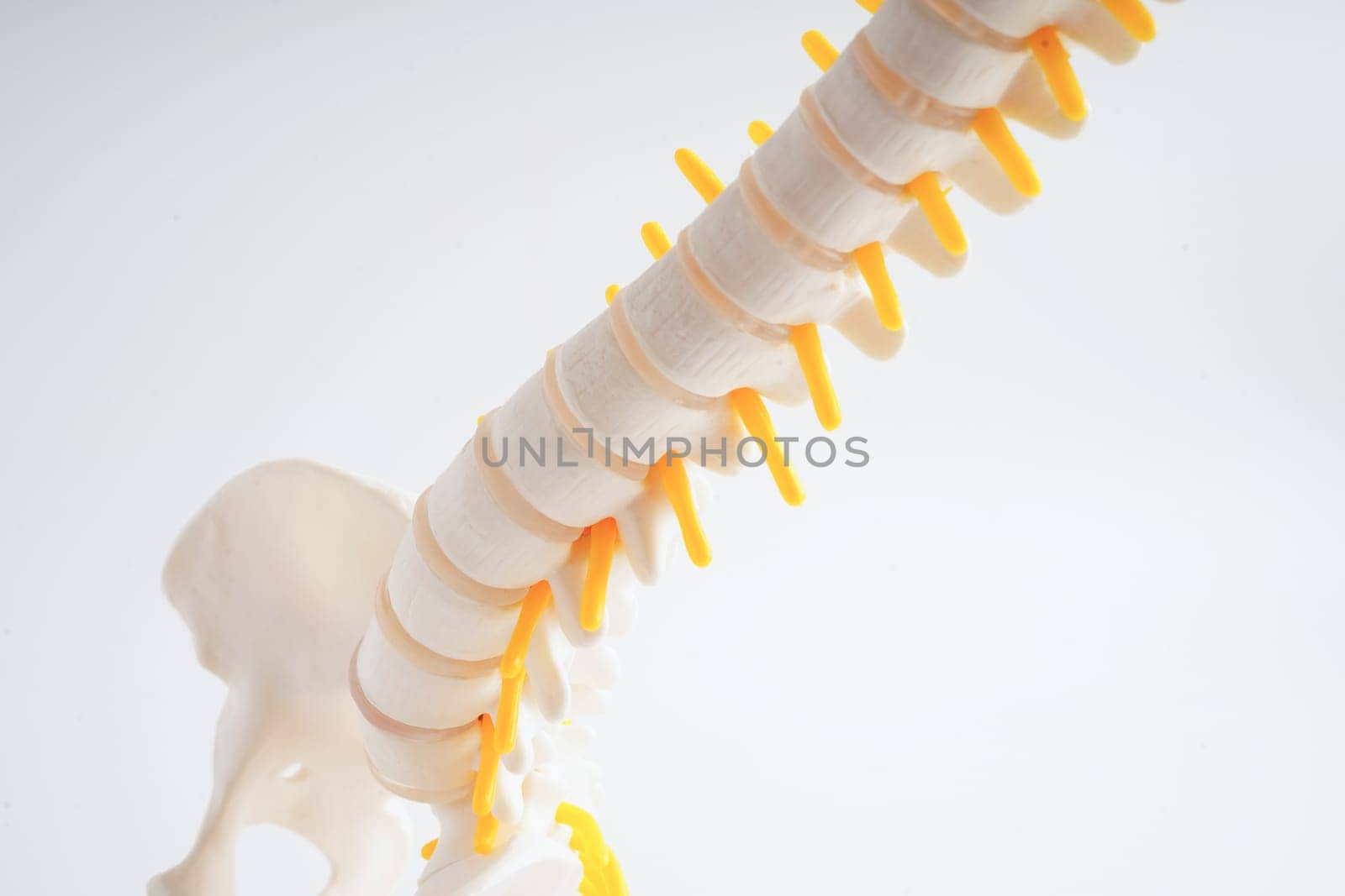 Spinal nerve and bone, Lumbar spine displaced herniated disc fragment, Model for treatment medical in the orthopedic department.