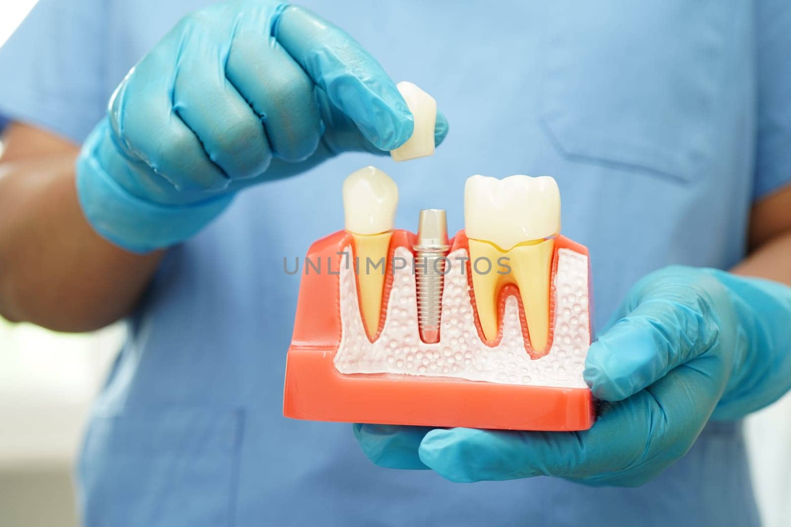 Doctor hold dental implant, artificial tooth roots into jaw, root canal of dental treatment, gum disease, teeth model for dentist studying about dentistry.