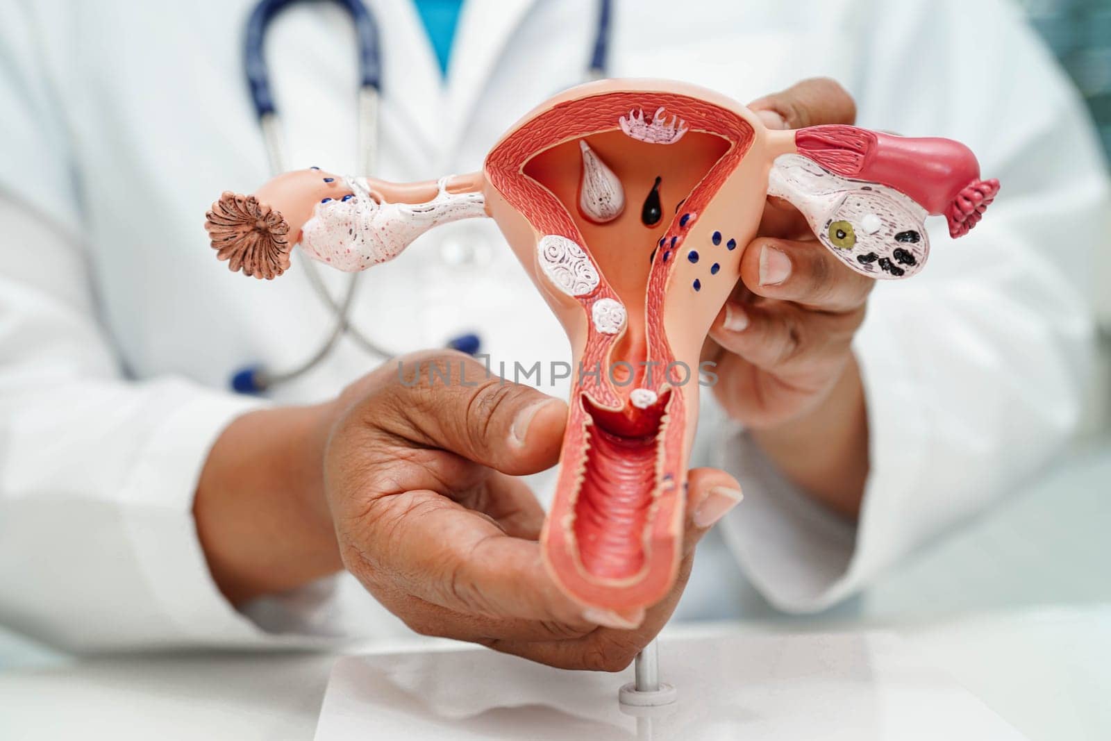Uterus, doctor holding human anatomy model for study diagnosis and treatment in hospital.