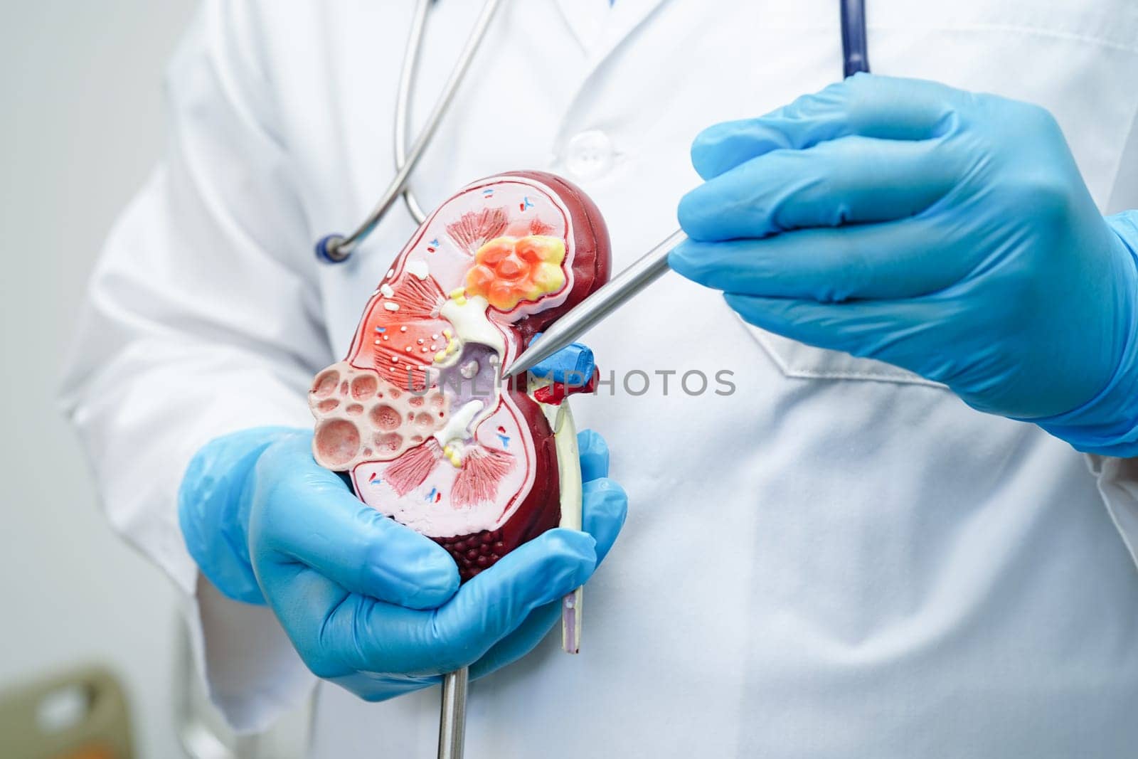 Chronic kidney disease, doctor with model for treatment urinary system, urology, Estimated glomerular filtration rate eGFR.