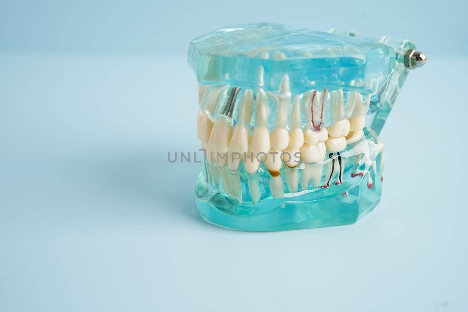 Dental implant, artificial tooth roots into jaw, root canal of dental treatment, gum disease, teeth model for dentist studying about dentistry.
